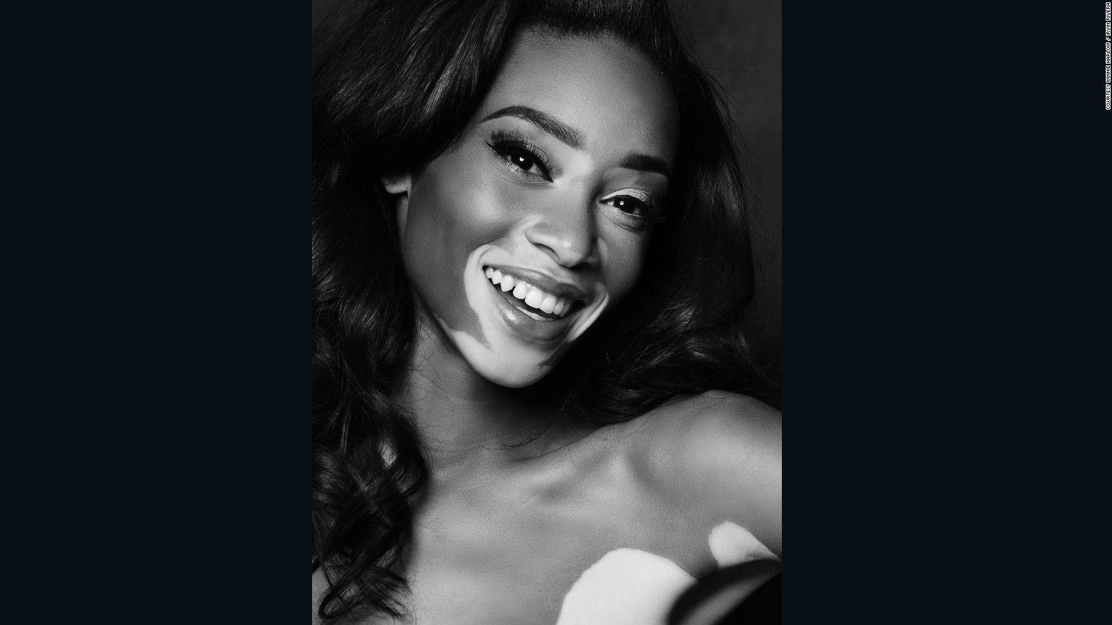 Model Winnie Harlow is changing the face of fashion Style