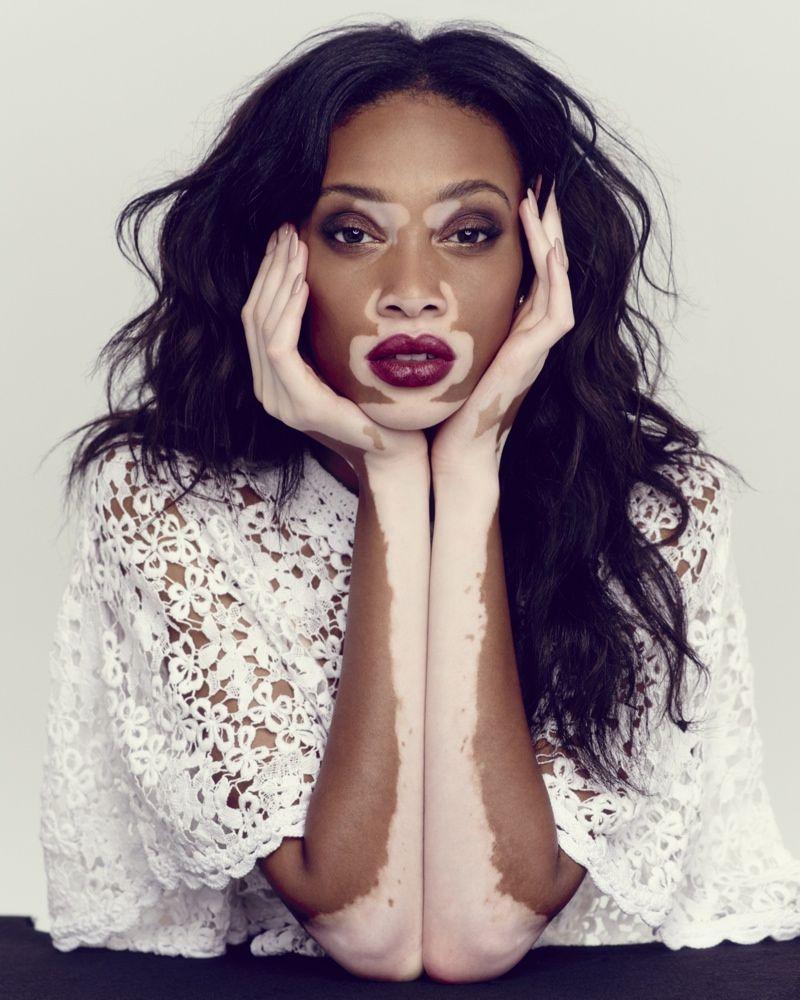 Winnie Harlow Photo: Her Campaigns for Desigual & Diesel