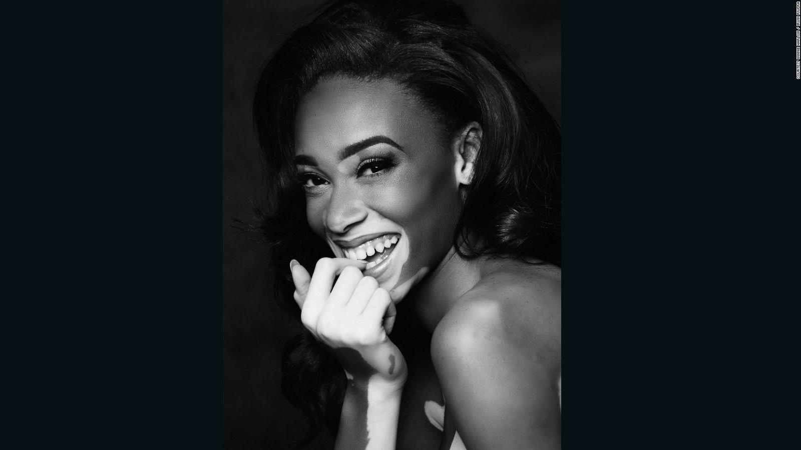 Winnie Harlow's changing the face of fashion