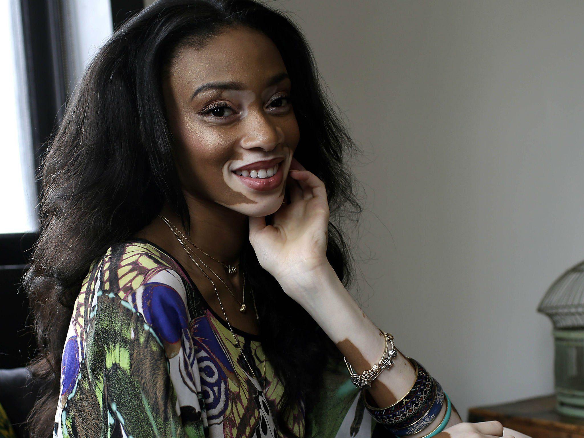 Winnie Harlow: Everything you need to know about the star