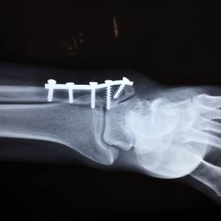 Broken bones wallpaper