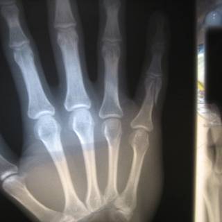 Broken bones wallpaper