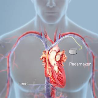 Pacemaker wallpaper