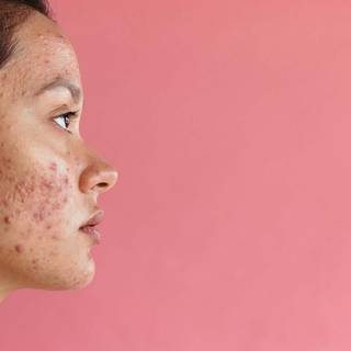 Pimple girl wallpaper