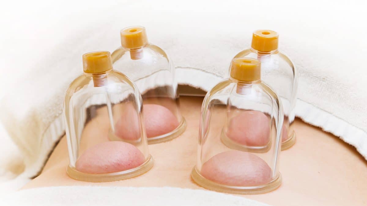 How Cupping Therapy Works Like Magic to Help with High Blood Pressure