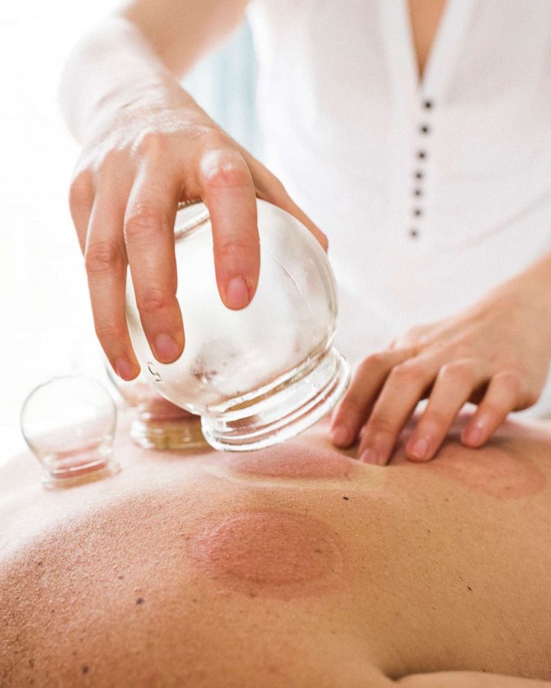 Everything you need to know about cupping, a traditional Chinese medical technique
