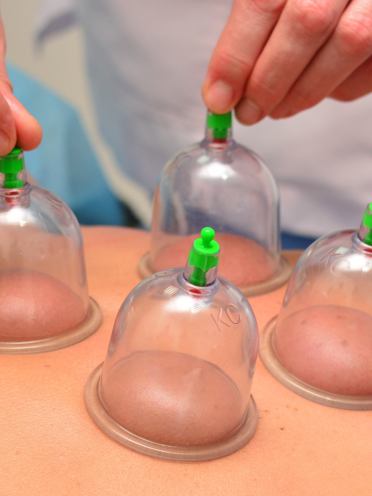 What Is Cupping Treatment? Man Left With Bruises After Cupping