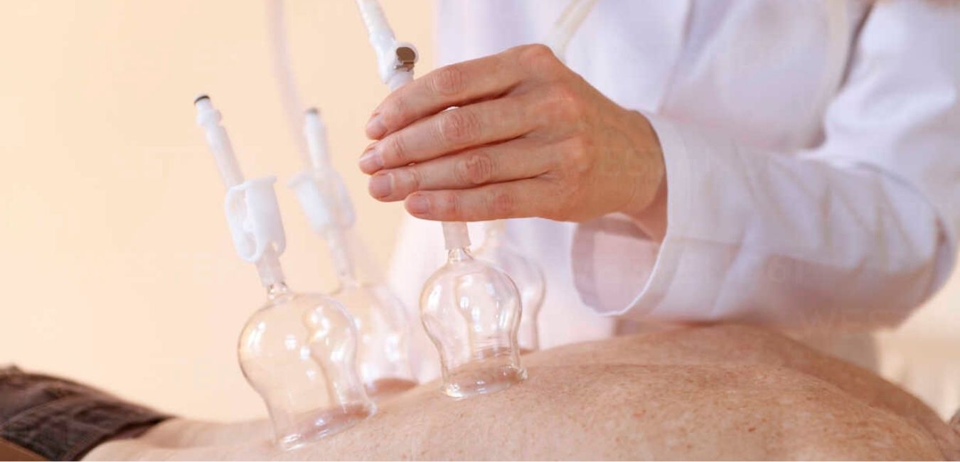 Hijama and Cupping