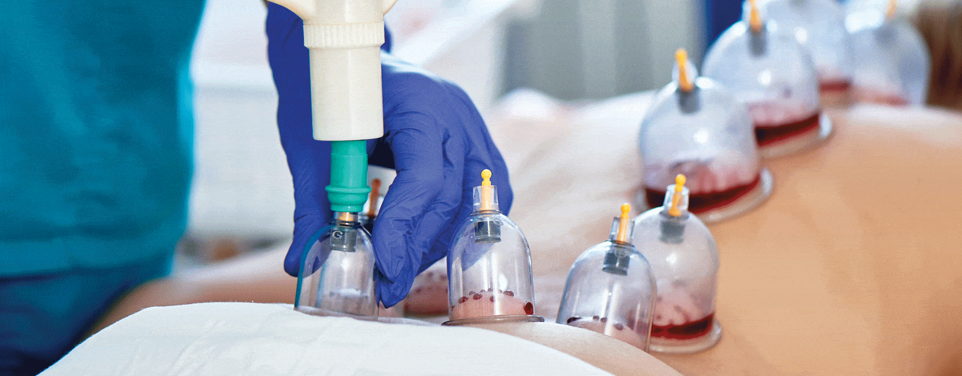 Cupping therapy. Natural therapy process for body