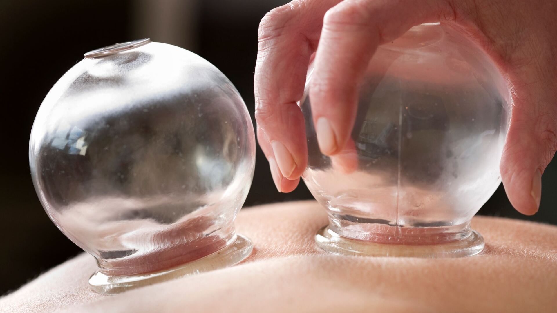 Cupping Therapy