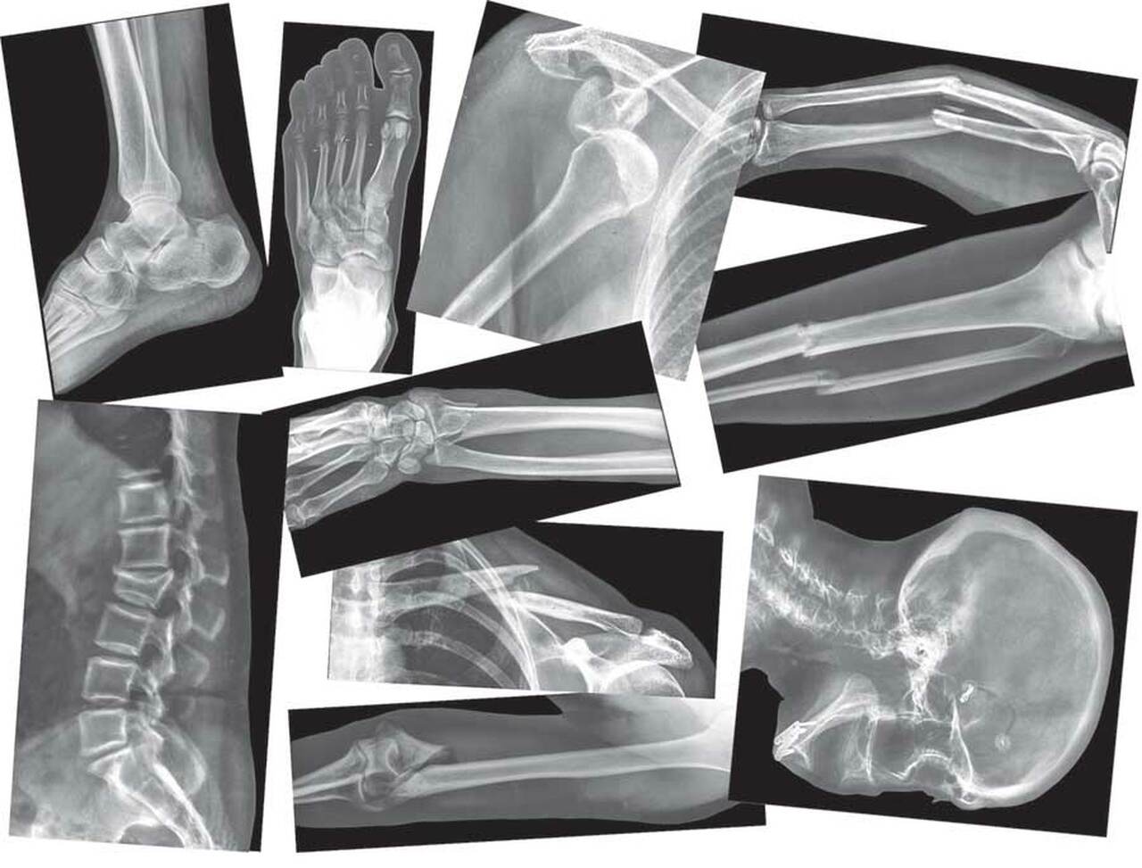 Broken Bones X Ray Set. Home Science Tools