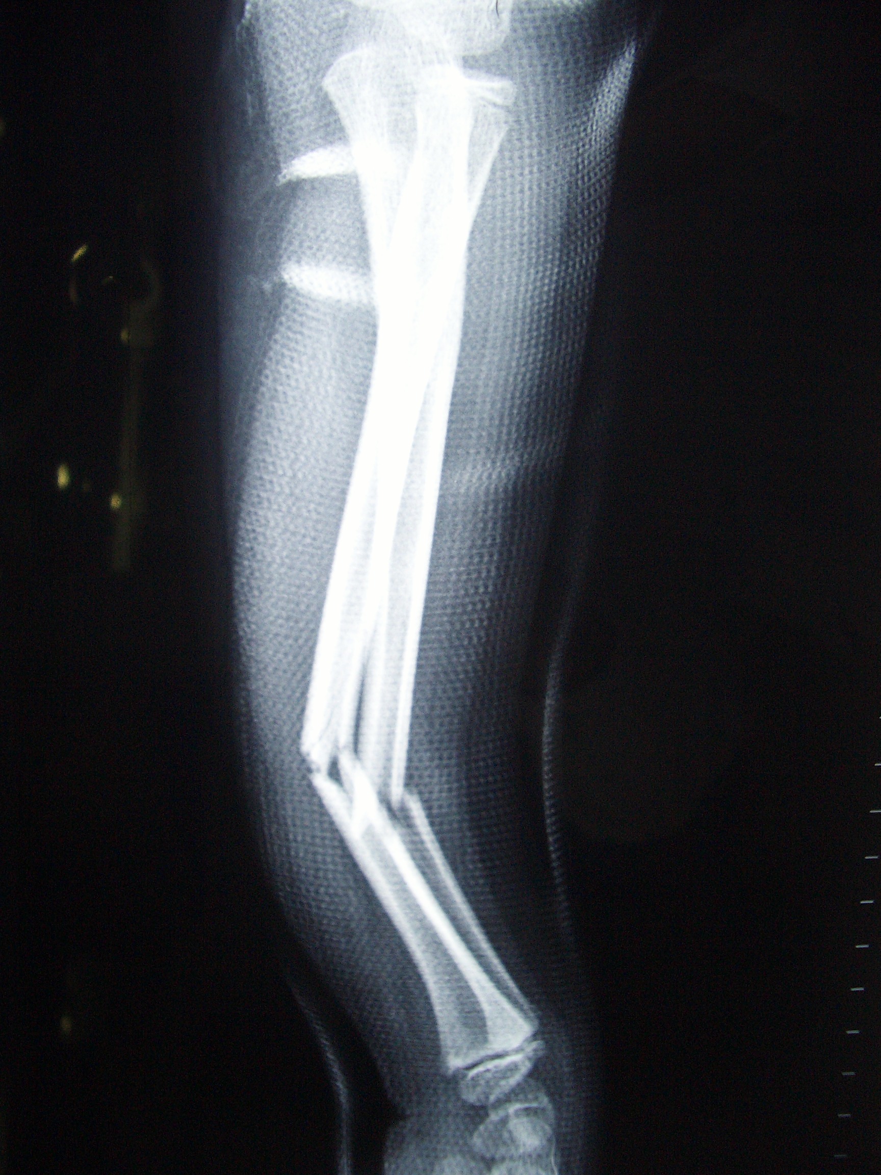 Broken Bone Archives. Singapore Sports & Orthopaedic Surgeon