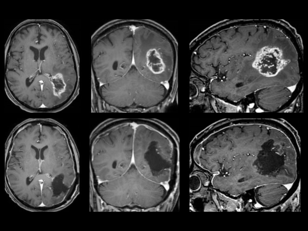 Randy D'Amico, MD. Maximal. Resection