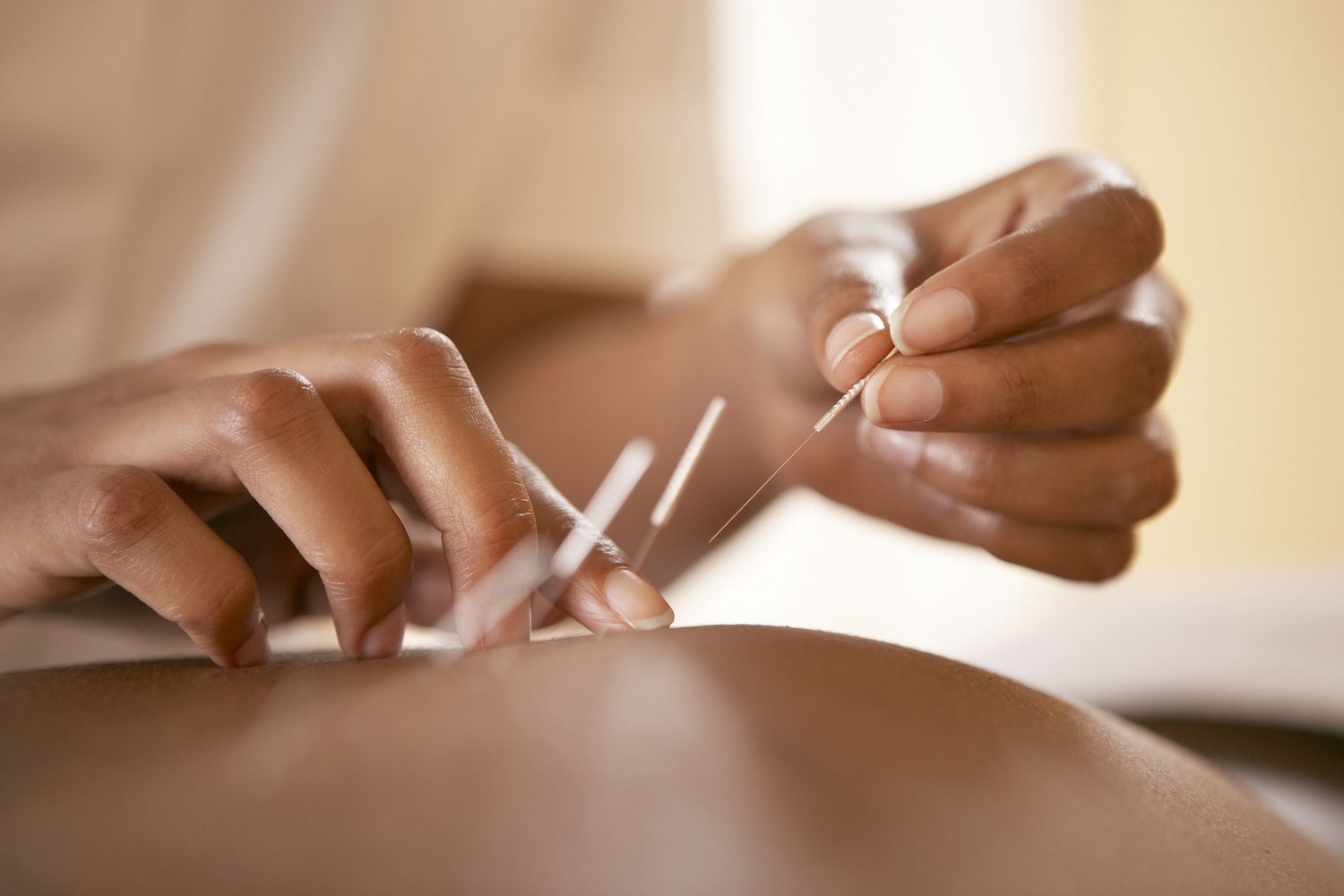 Acupuncture: The Benefits, How It Works, and Side Effects