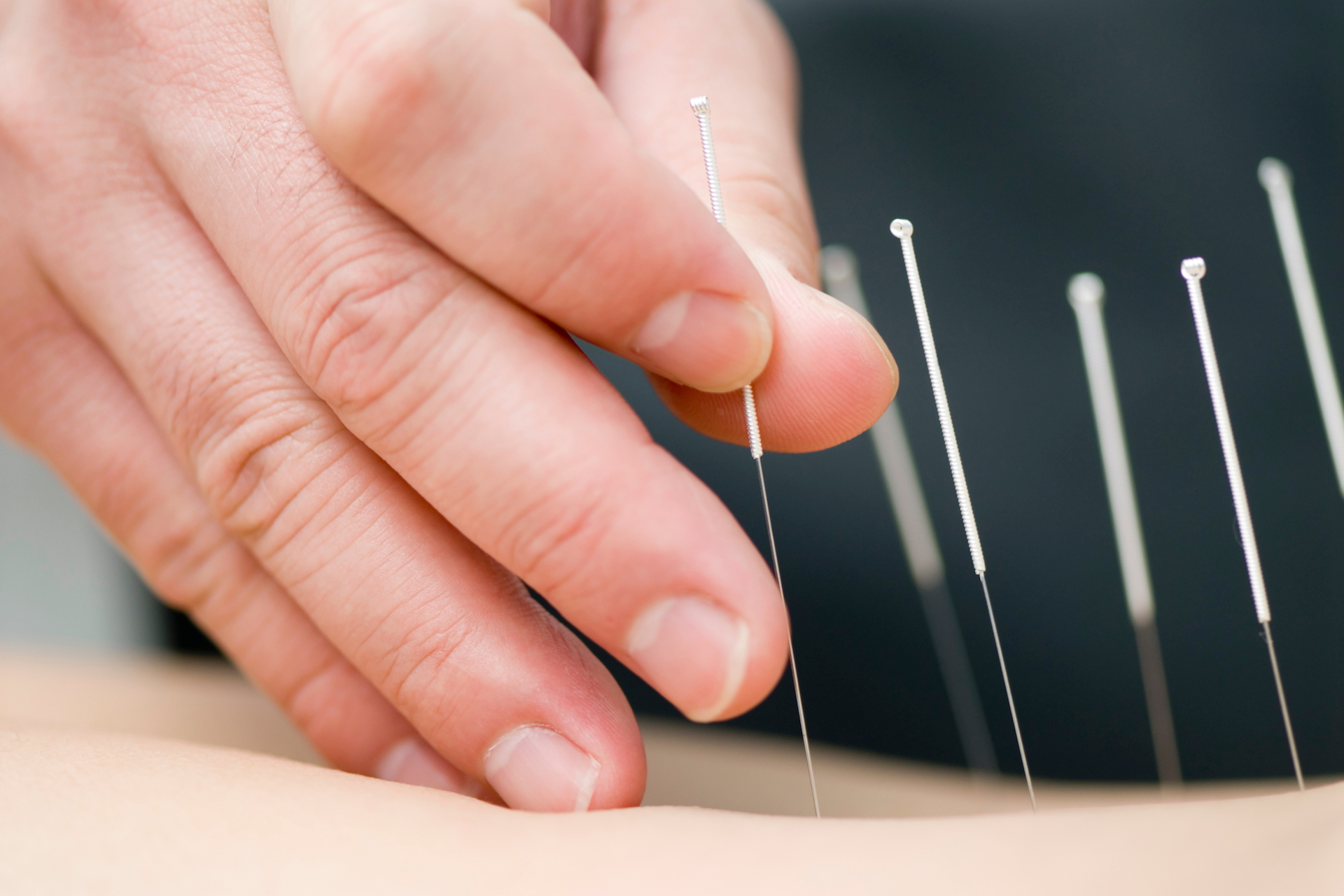 Acupuncture for Sciatica: Everything You Need to Know