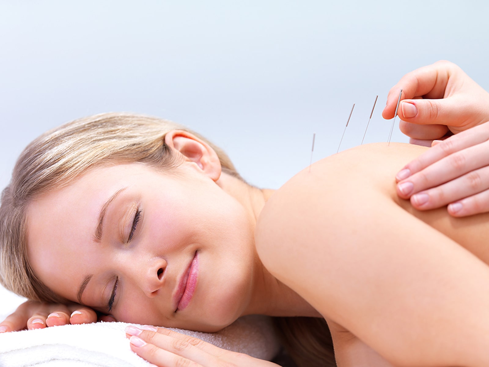Acupuncture. Arlington Chiropractic Clinic in Arlington Heights, IL