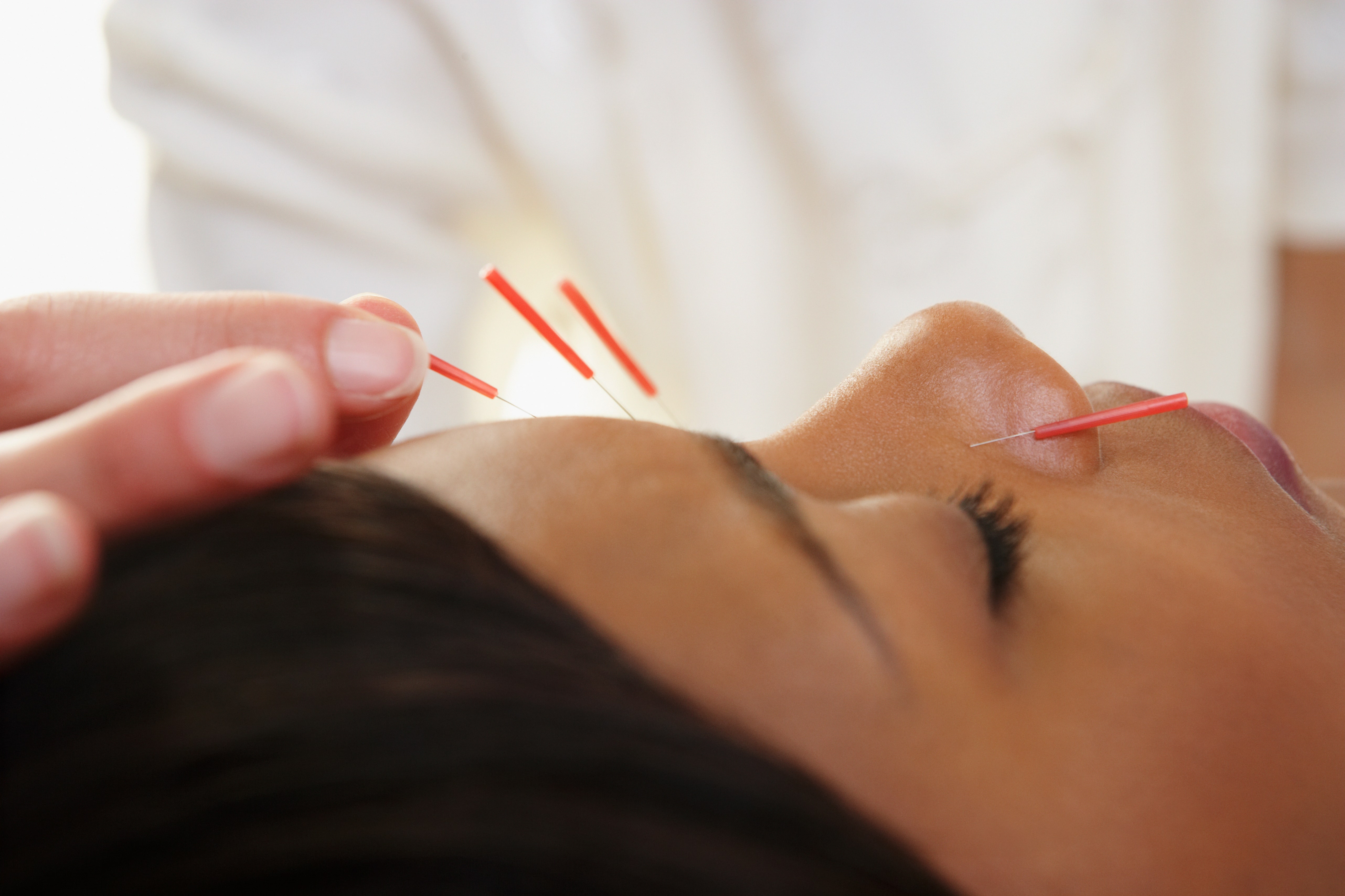 How Acupuncture Cured One Woman's Acne