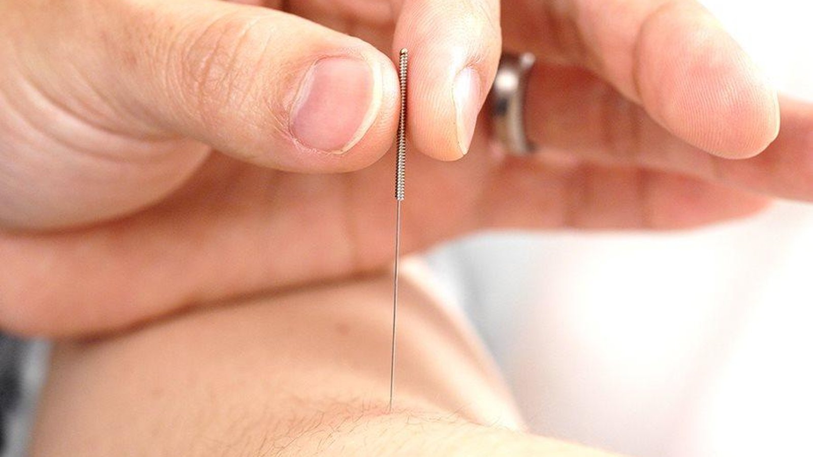 Effective Acupuncture