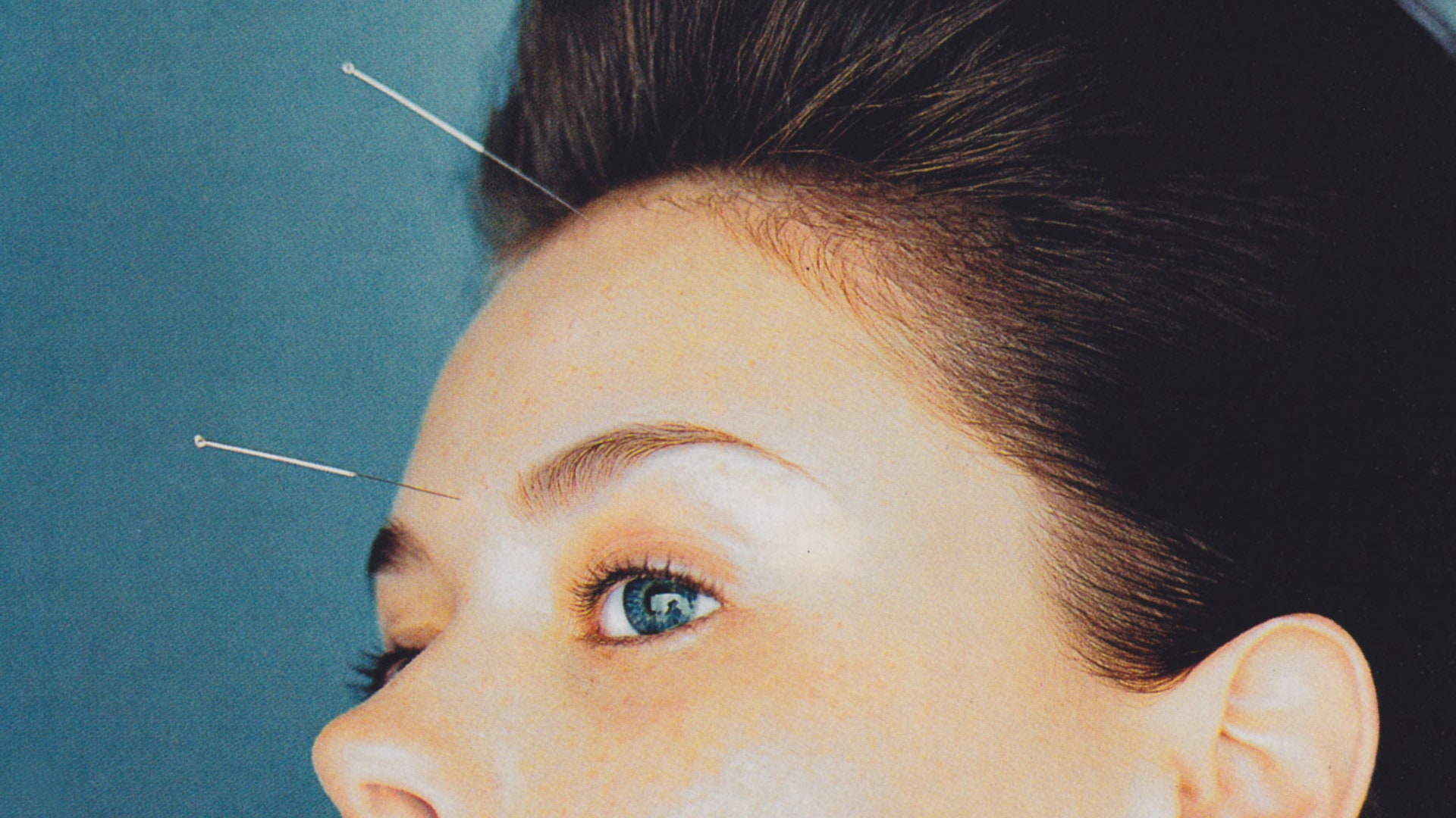 Gotham Wellness's Facial Acupuncture Treatment Is the Key to Glowing Spring Skin