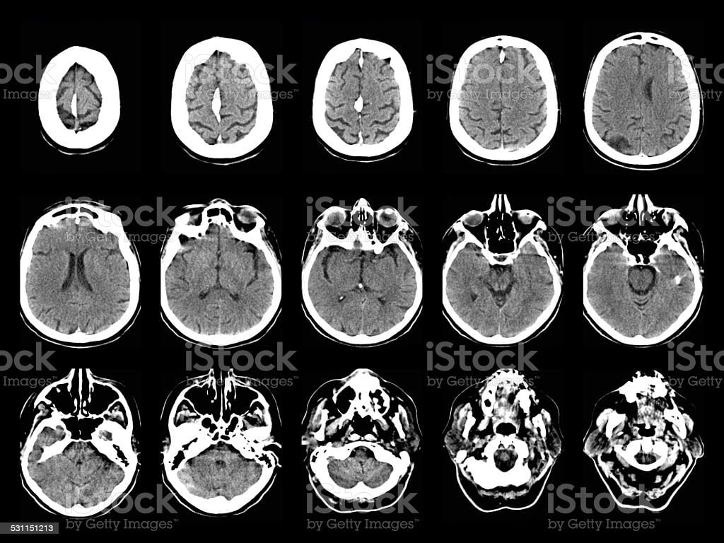 Stroke On Ct Scans Image Now