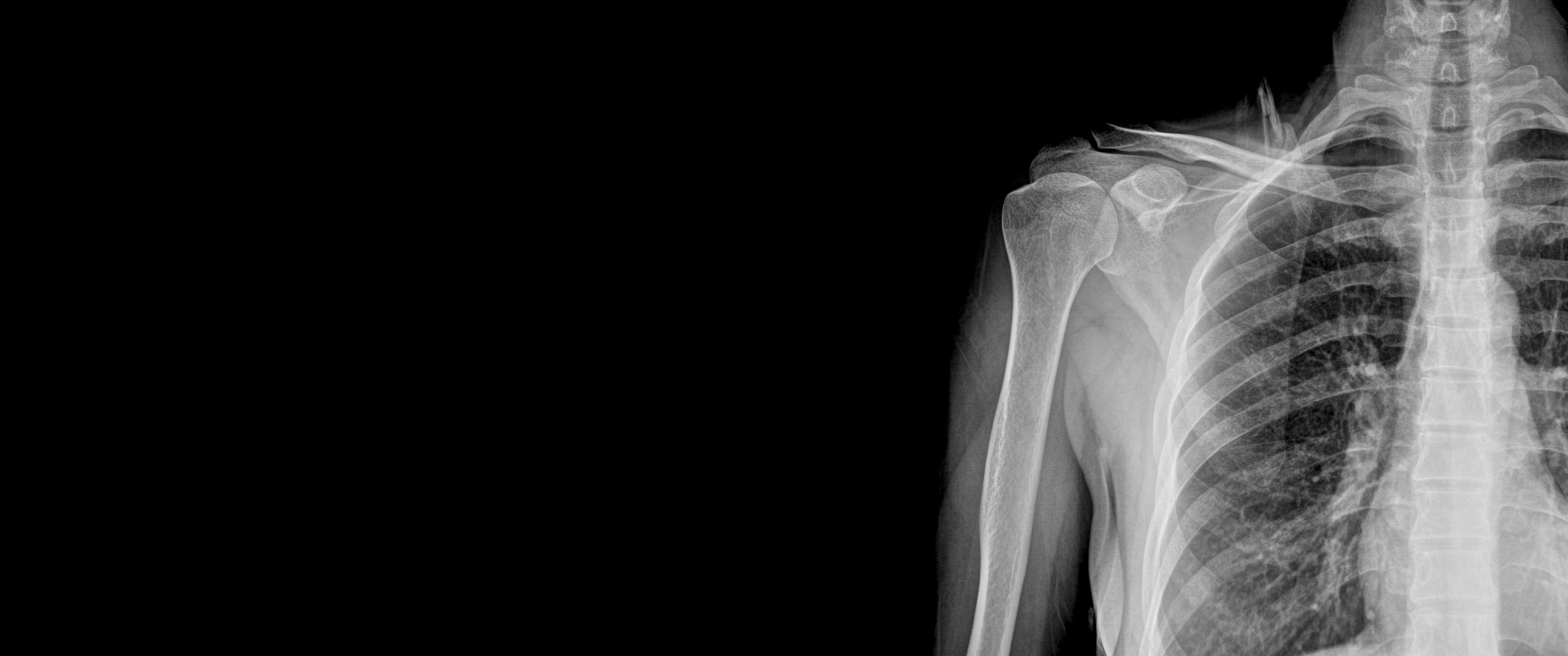 x ray wallpaper, shoulder, radiography, joint, x ray, radiology, medical imaging, arm, neck, black and white, human body