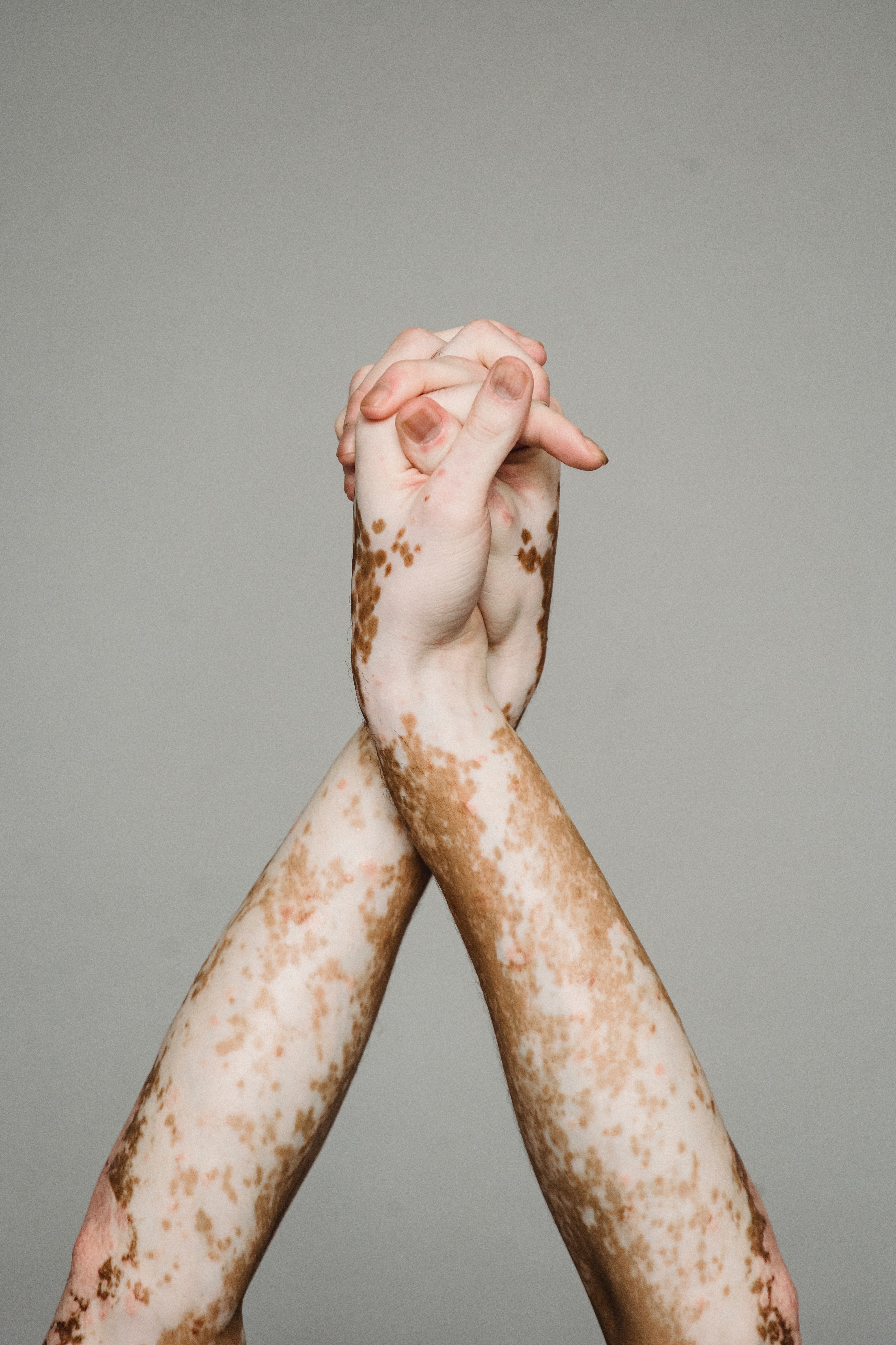 Best Free Vitiligo & Image · 100% Royalty Free HD Downloads