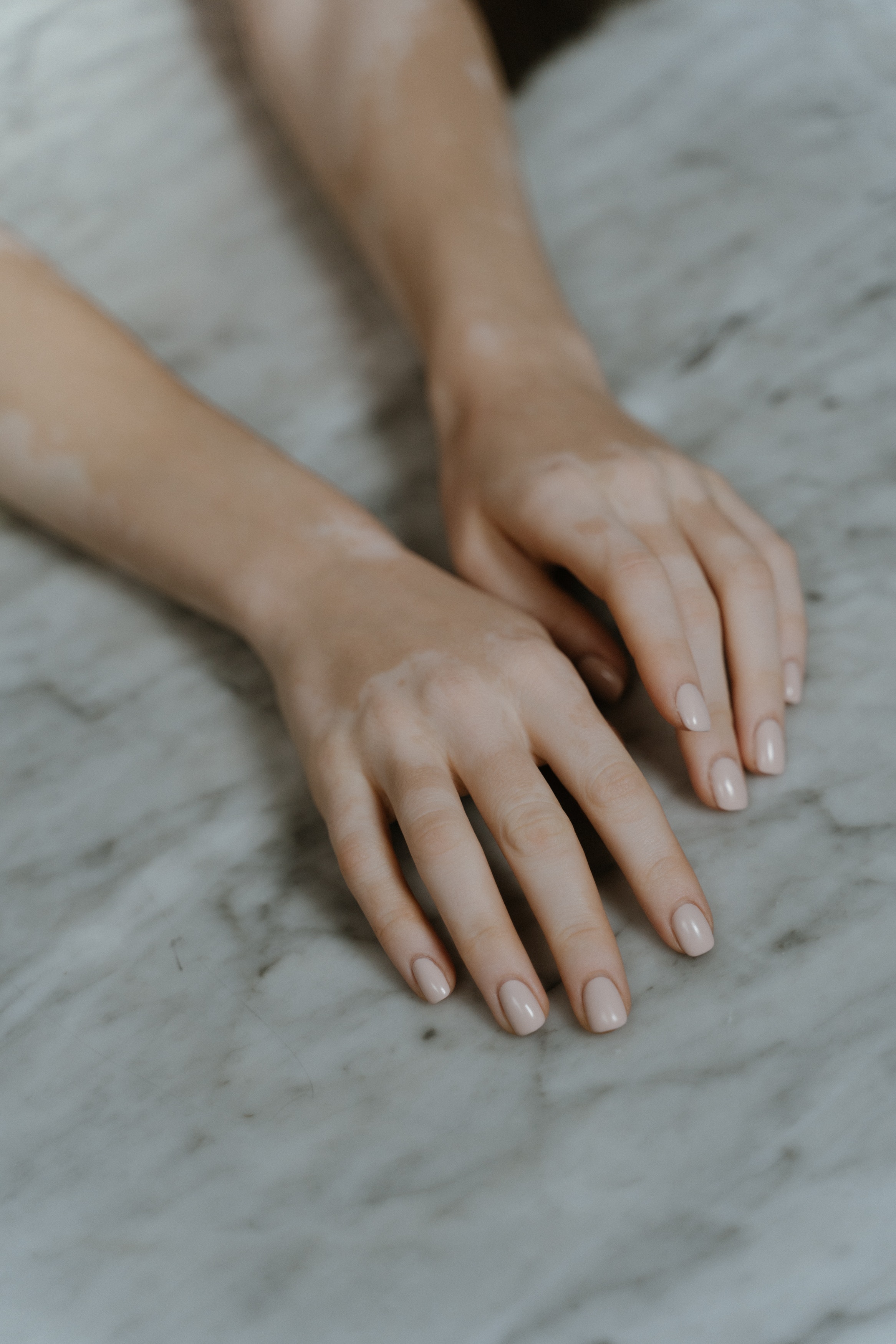 Best Free Vitiligo & Image · 100% Royalty Free HD Downloads