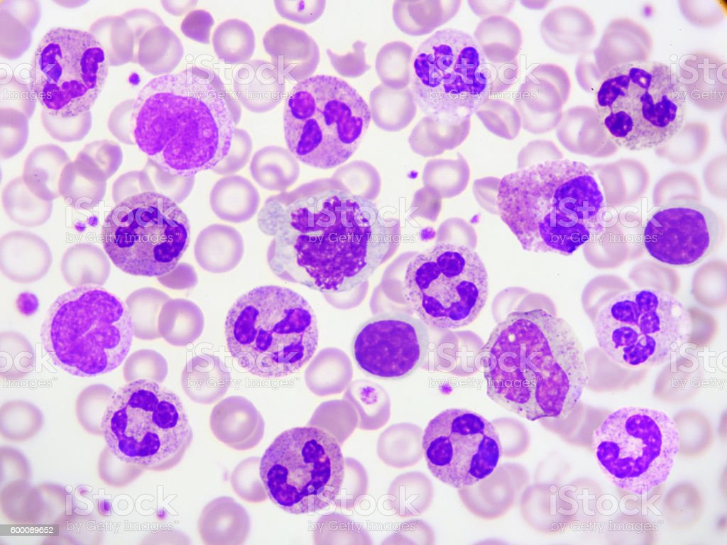White Blood Cells Image Now, Eosinophil, Leukemia