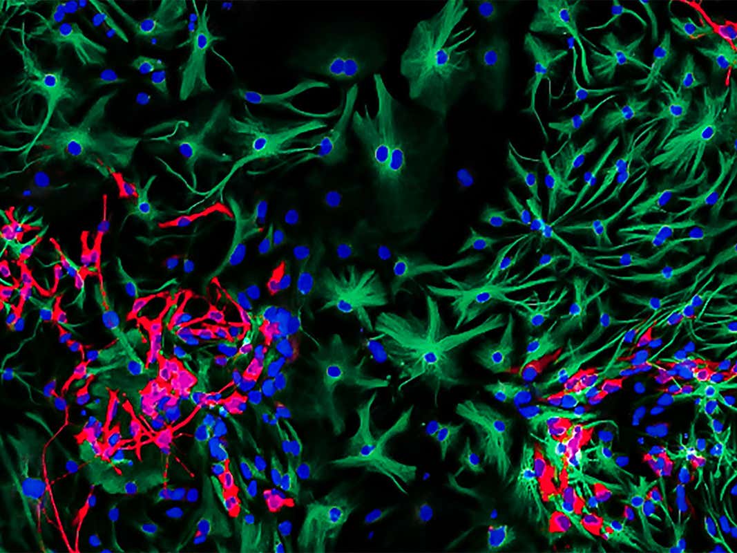 Close Up Image Of Brain Cancer Cells Wins Photography Prize