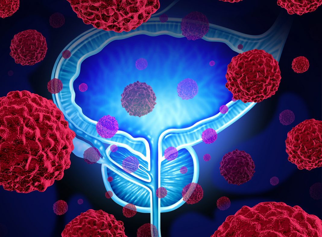 New Prostate Cancer Test Isolates Cancer Cells from Urine. Inside Precision Medicine