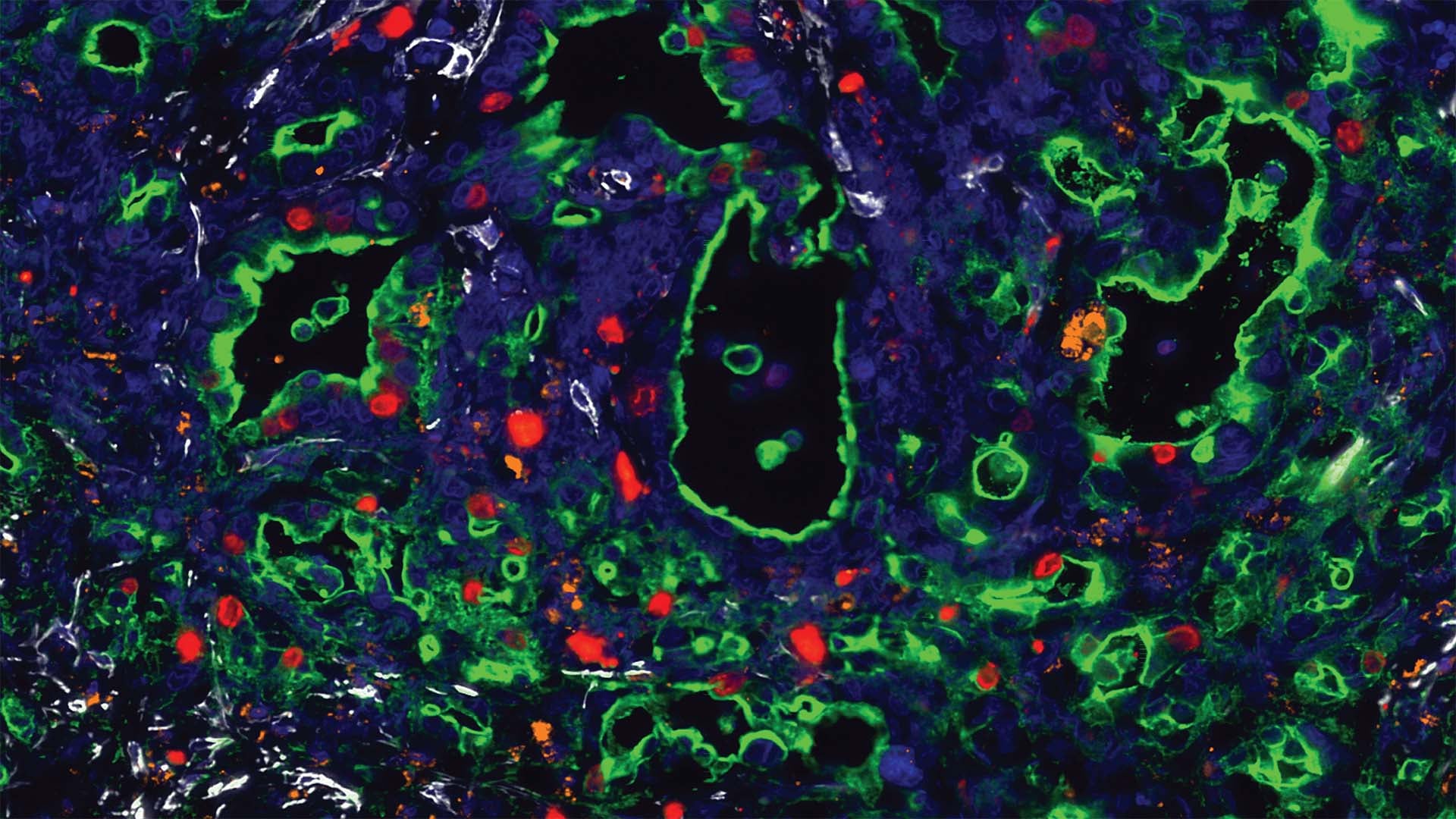 Why pancreatic ductal adenocarcinoma is so lethal Spring Harbor Laboratory