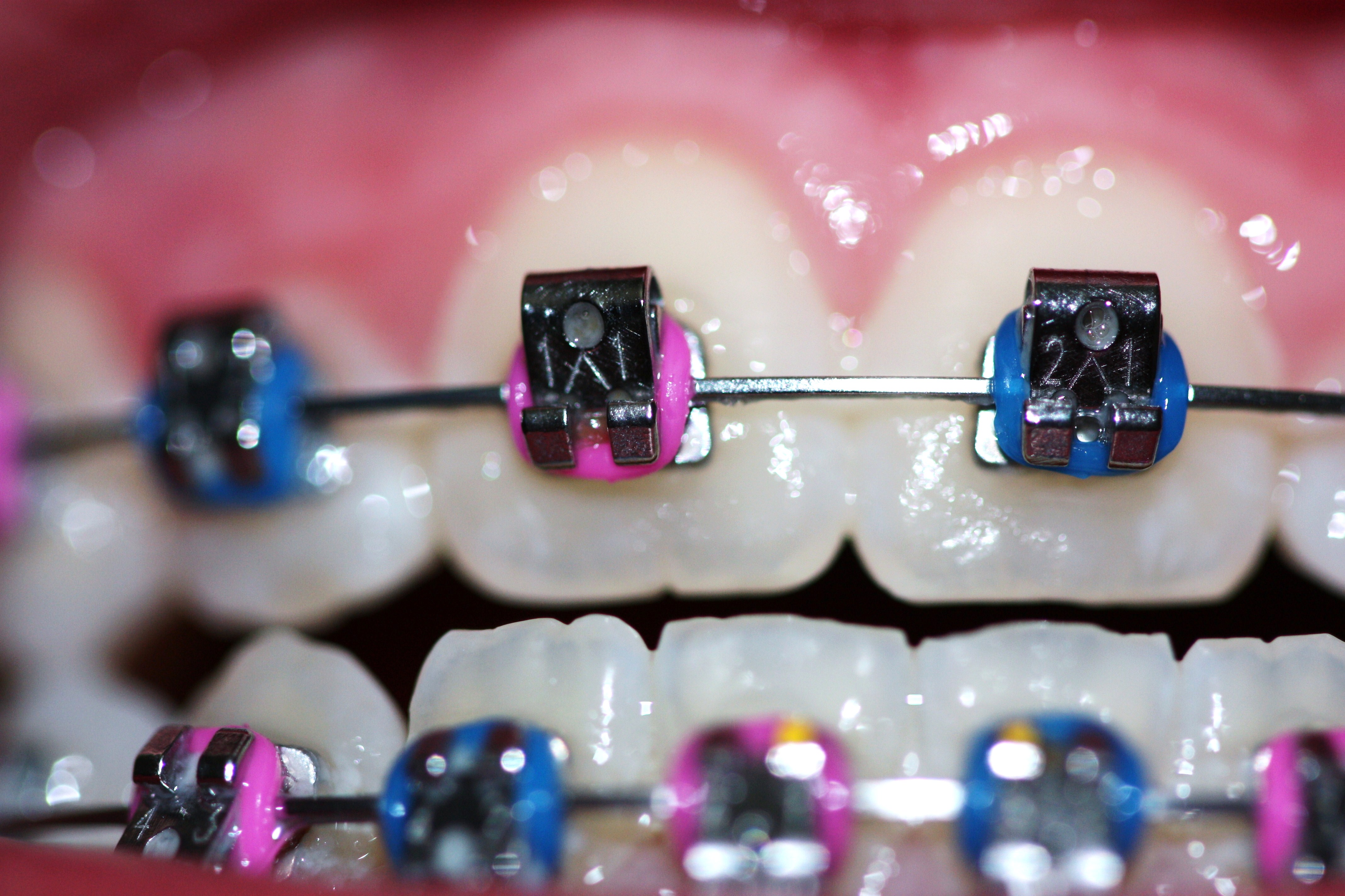 Wallpaper, flickr, flickrcolors, blue, pink, braces, braceface, orthodontics, catchycolorsflickrish, flickrland, fl imperfections, macromondays, silver, msh msh teeth, teef, orthodontia, metalmouth 4272x2848 - Wallpaper