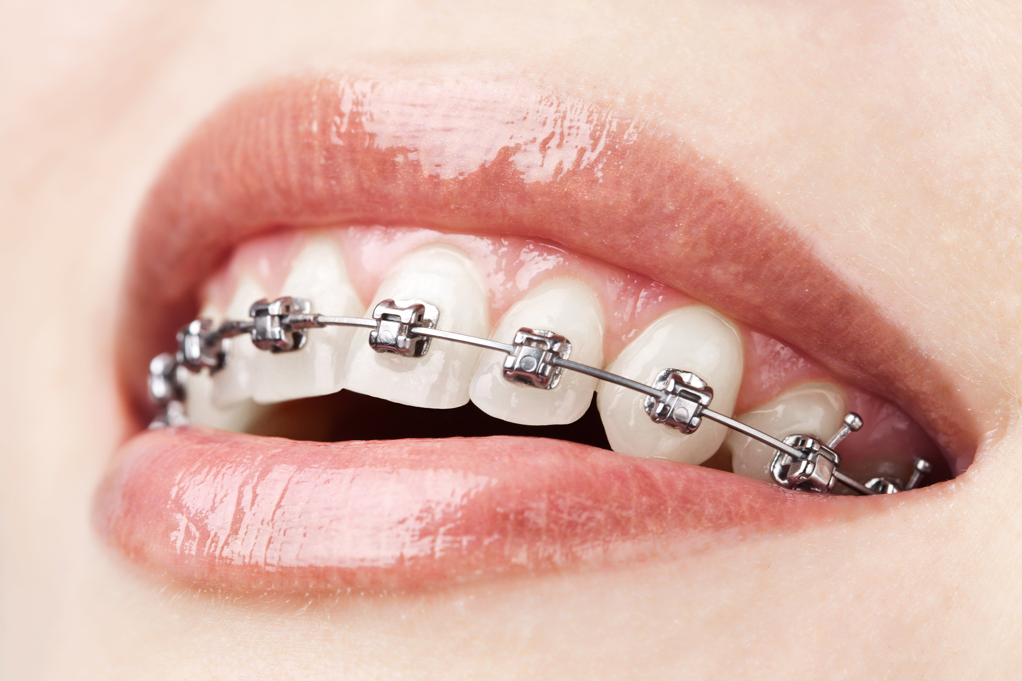Braces Can Actually Be Bad For Your Teeth