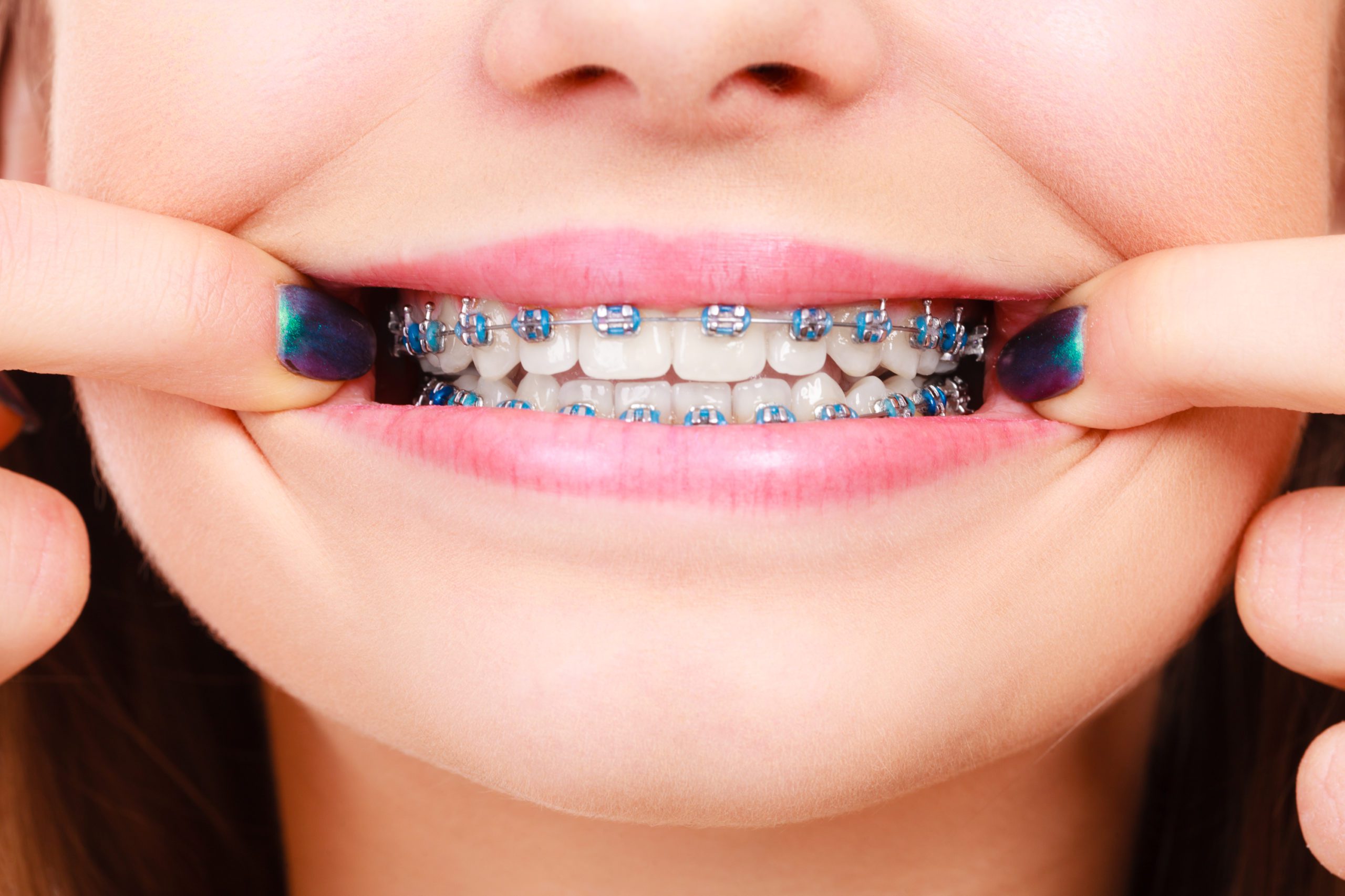 Fast Braces Can Help You Enjoy a Perfect Smile in Less Time