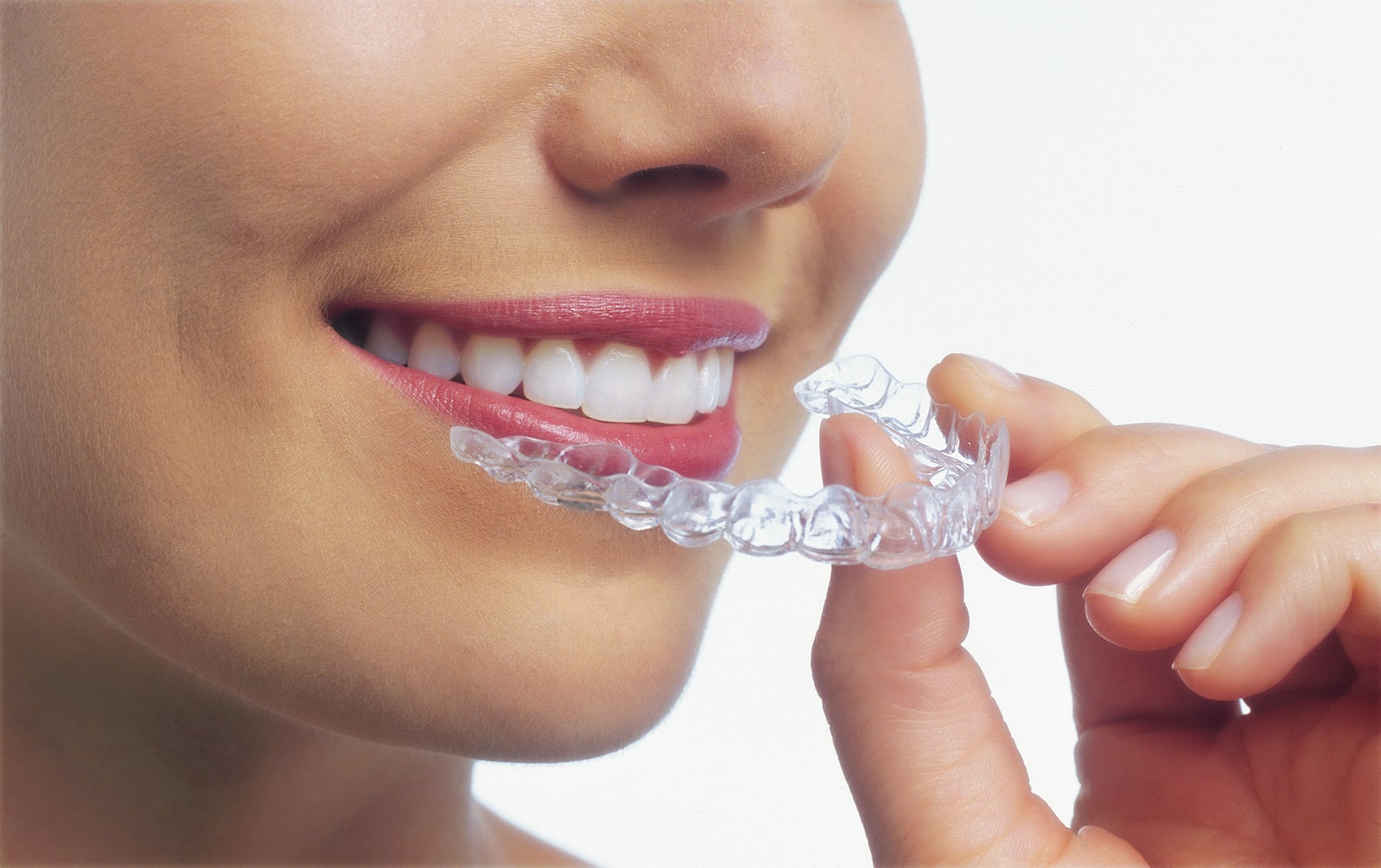 Fast Braces Can Help You Enjoy a Perfect Smile in Less Time