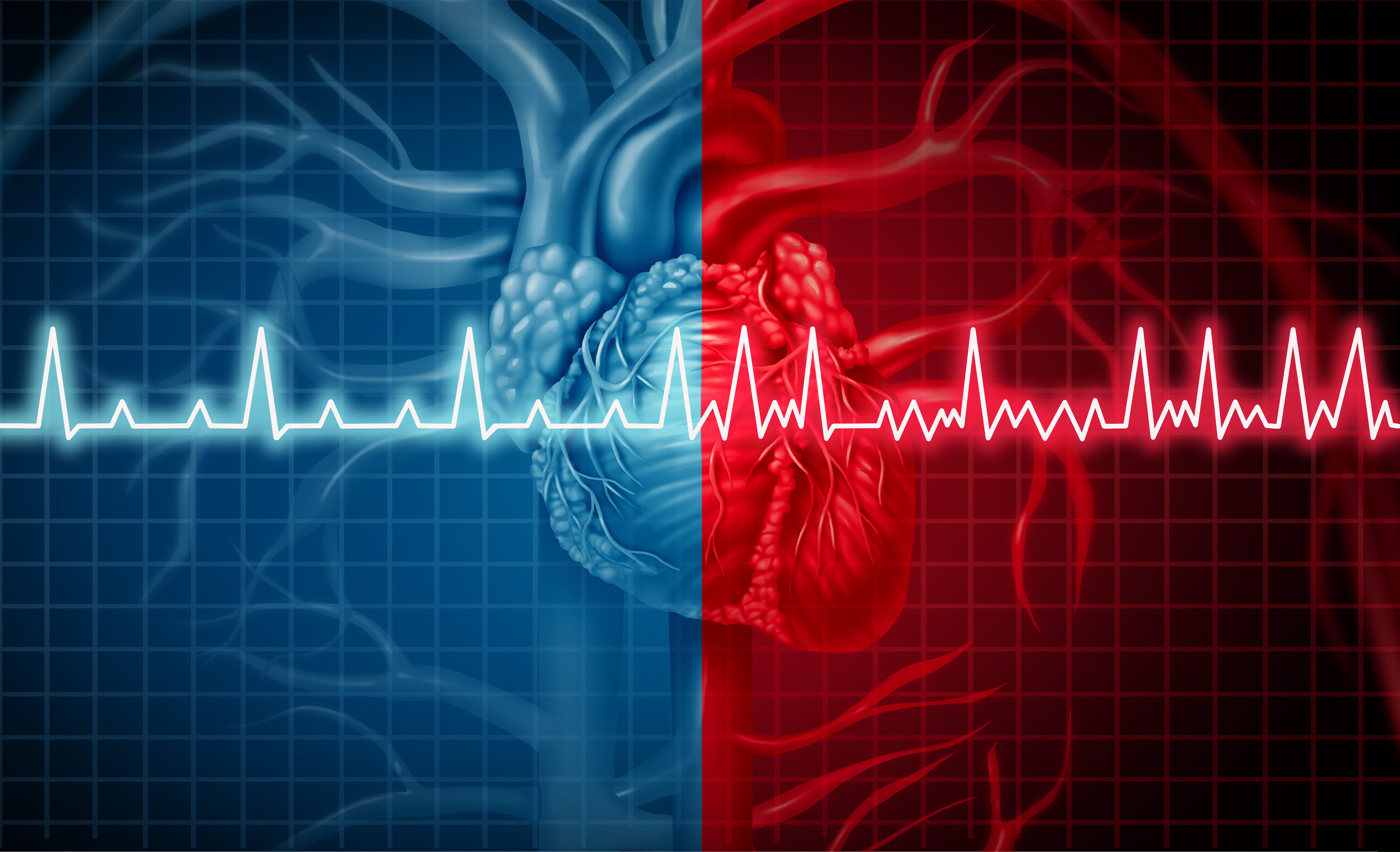 What Causes AFib and can it be Prevented?