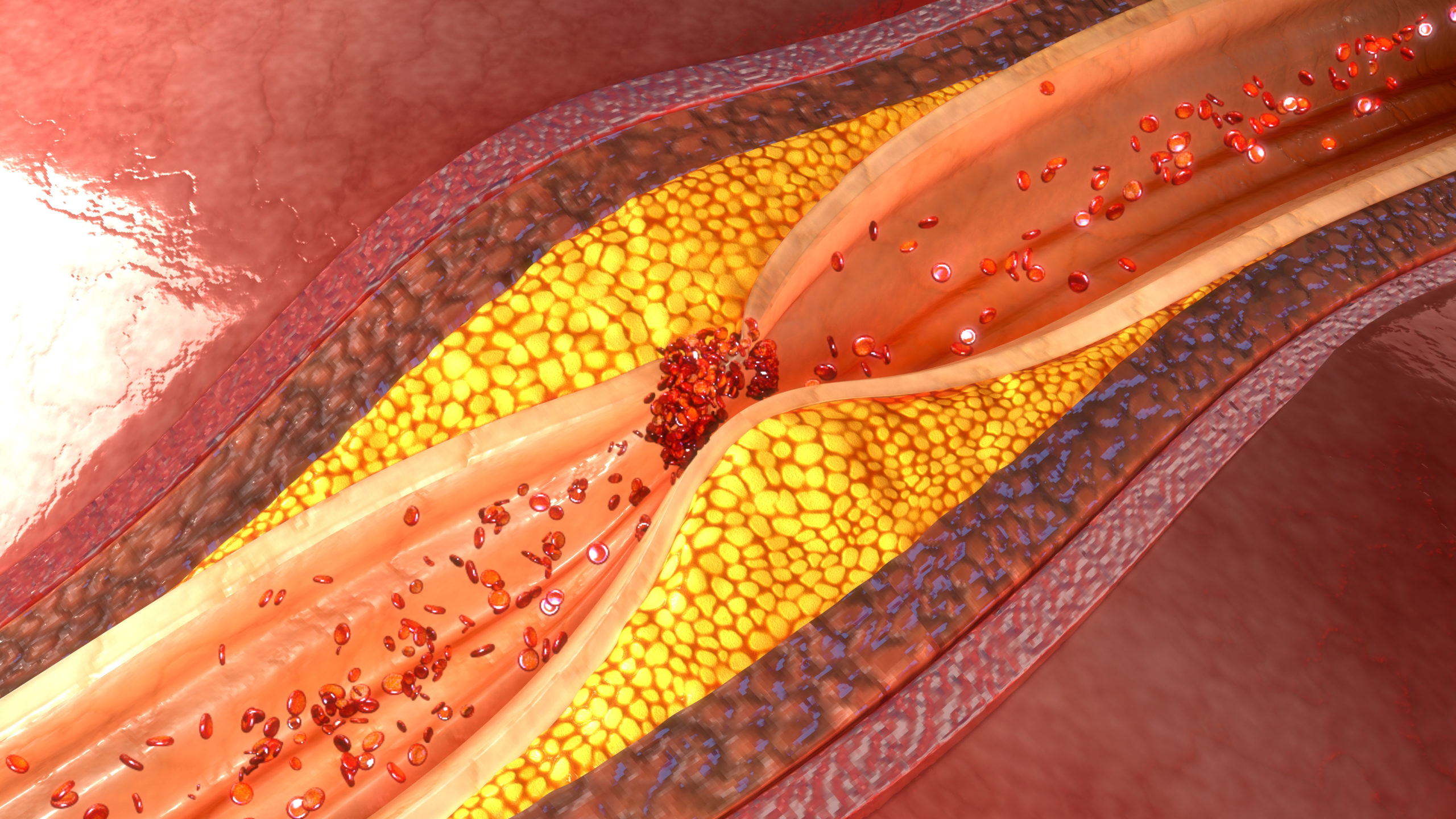 Treatments for Blocked Coronary Arteries