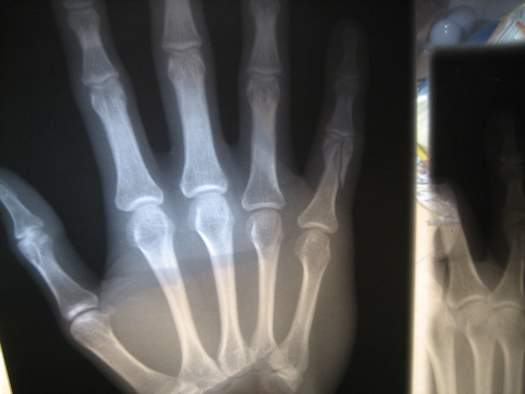 How Can I Tell if a Hospital or Doctor Misdiagnosed a Fracture? Thistle Law Firm