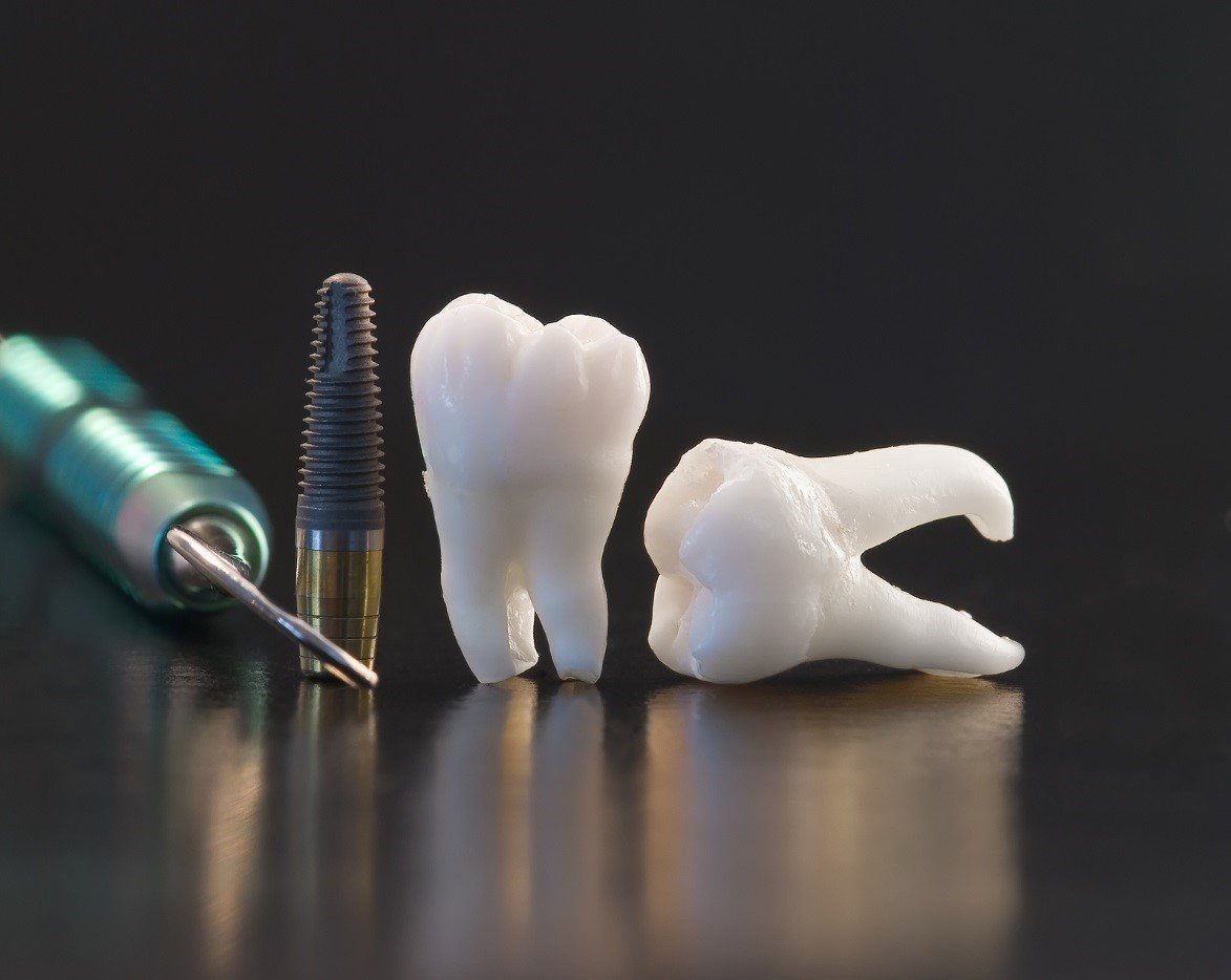 Dental Implants - Westerville, OH - Dr. Augusto S. Fojas