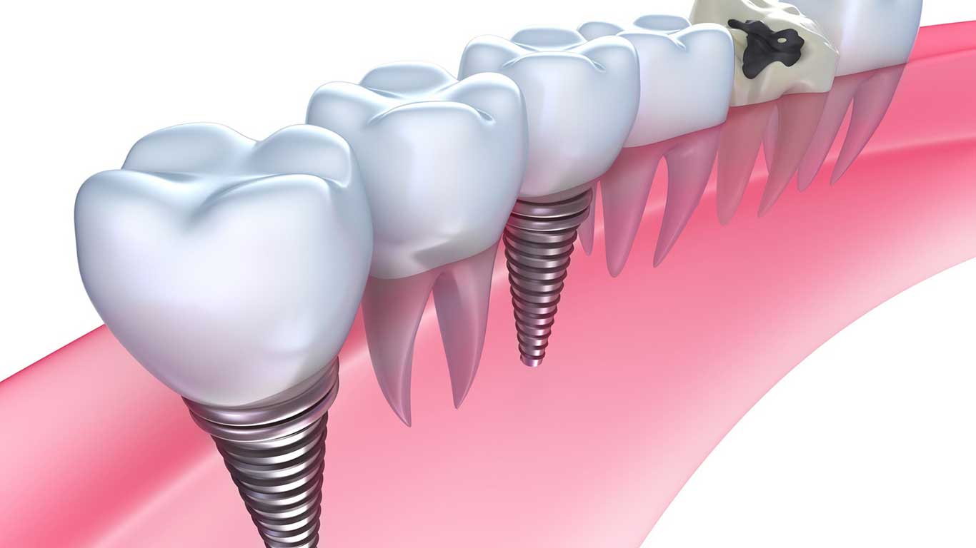 Oral Surgery Procedures | Dental Implants | Implant Dentist Eugene OR