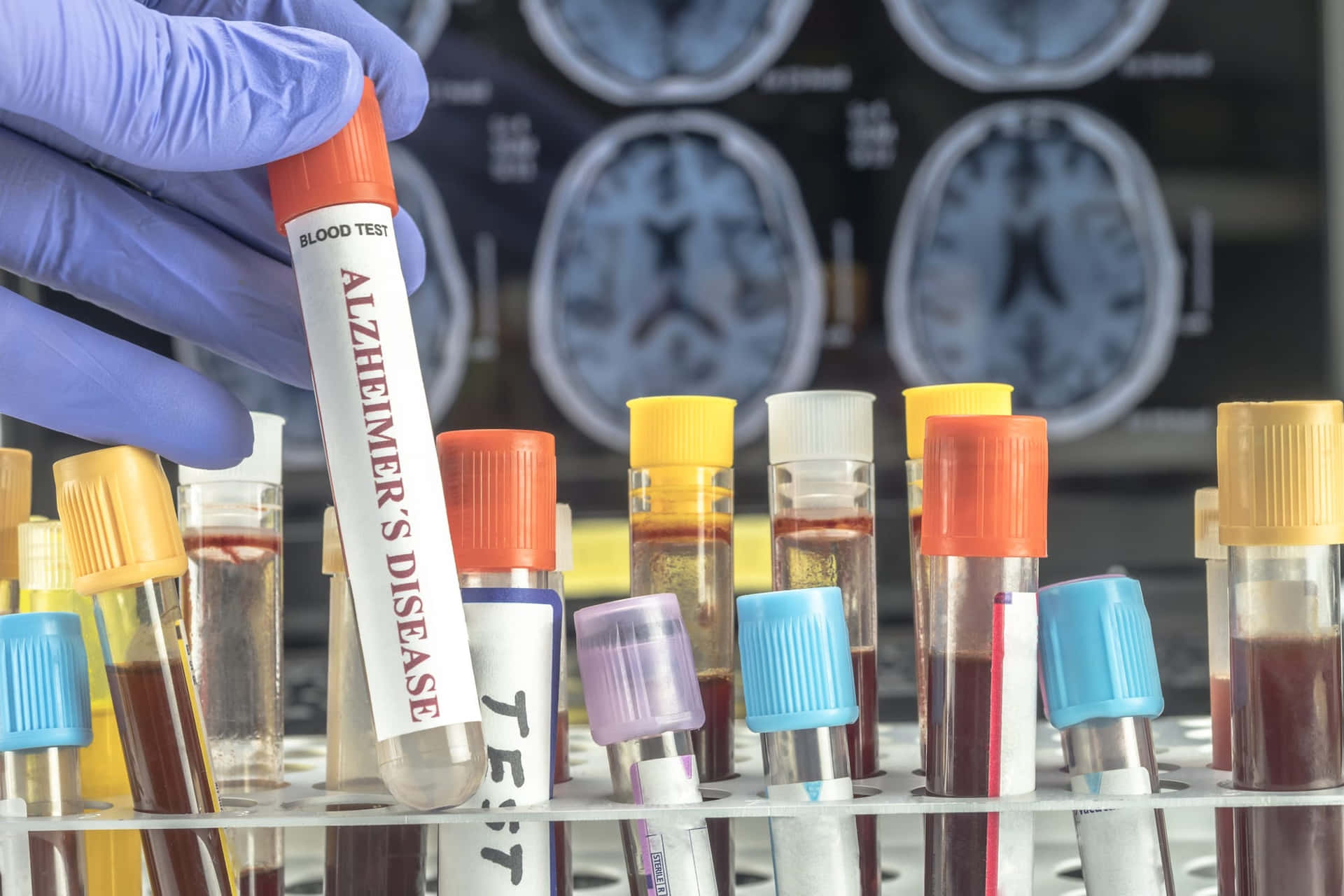 Download Laboratory Blood Sample Alzheimer's Wallpaper