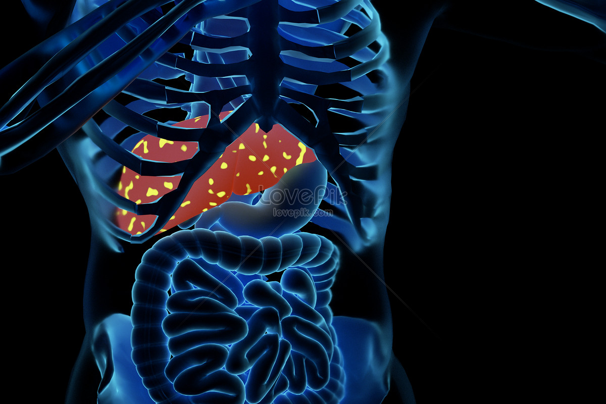 Fatty Liver Image, HD Picture For Free Vectors Download