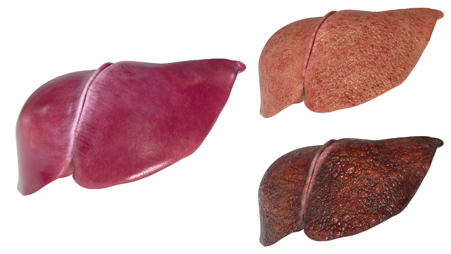 Healthy and cirrhotic liver