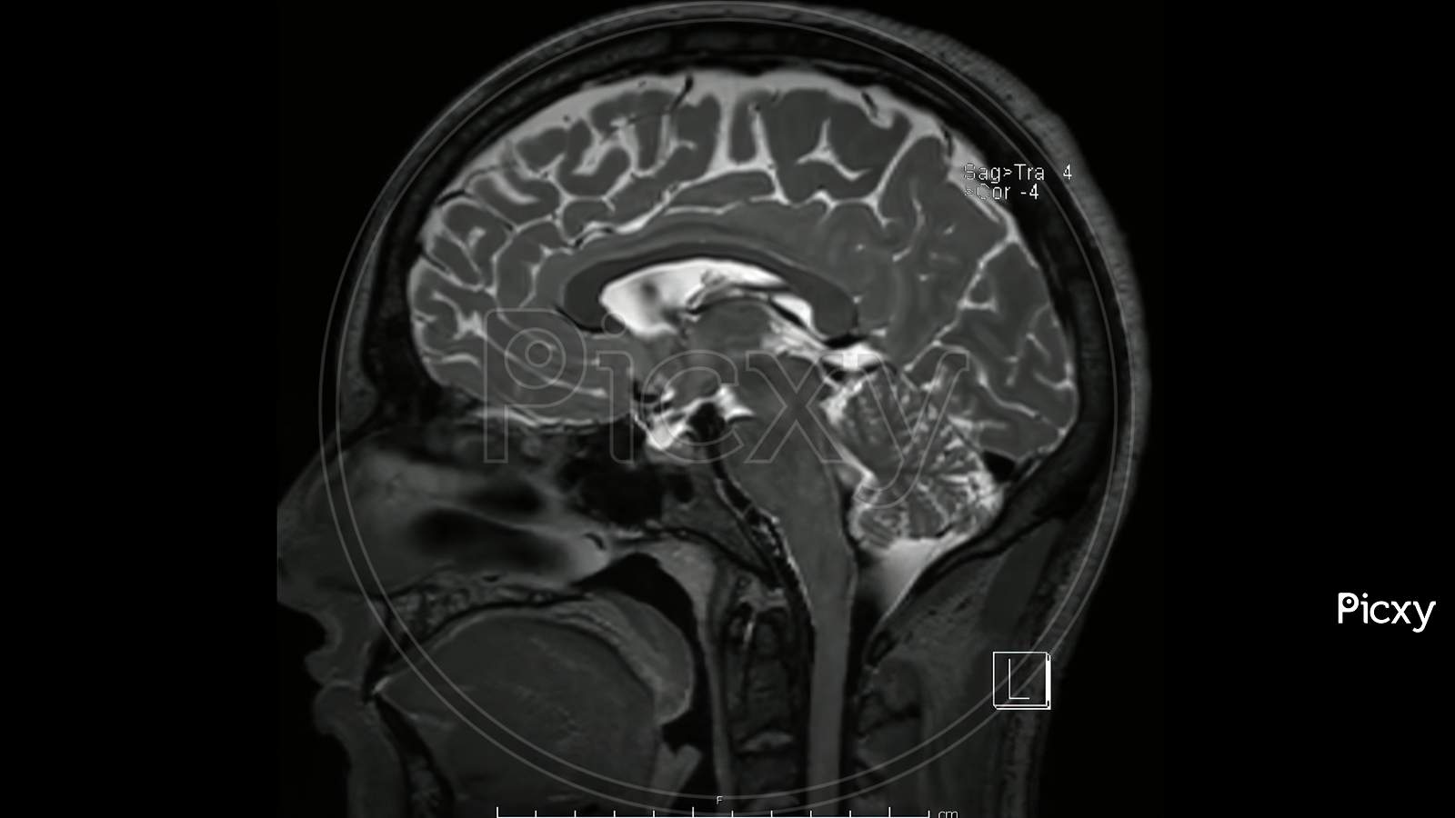 Image Of Magnetic Resonance Image Of The Brain (MRI Brain) Sagittal T2 Weighted Sequence TQ343635 Picxy