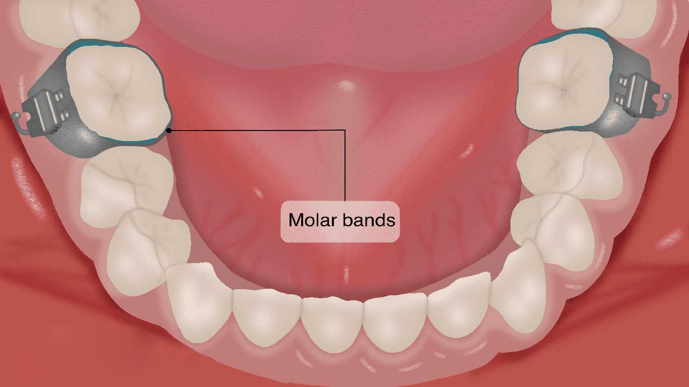 Molar Bands With Cleats In Orthodontics
