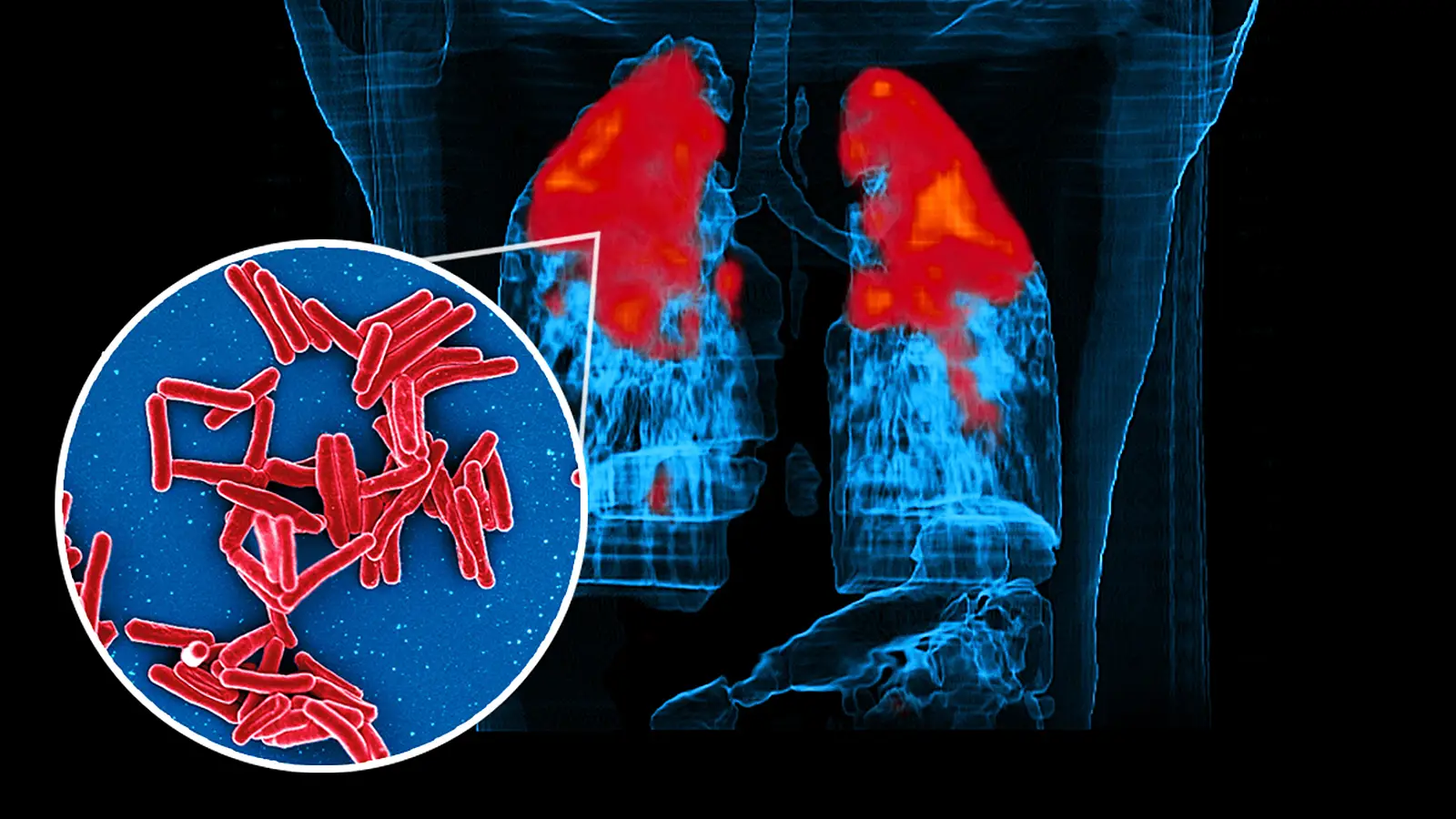 Beautiful What Happens If You Get Tb Artwork for Your Screen Beautiful What Happens If You Get Tb Artwork for Your Screen