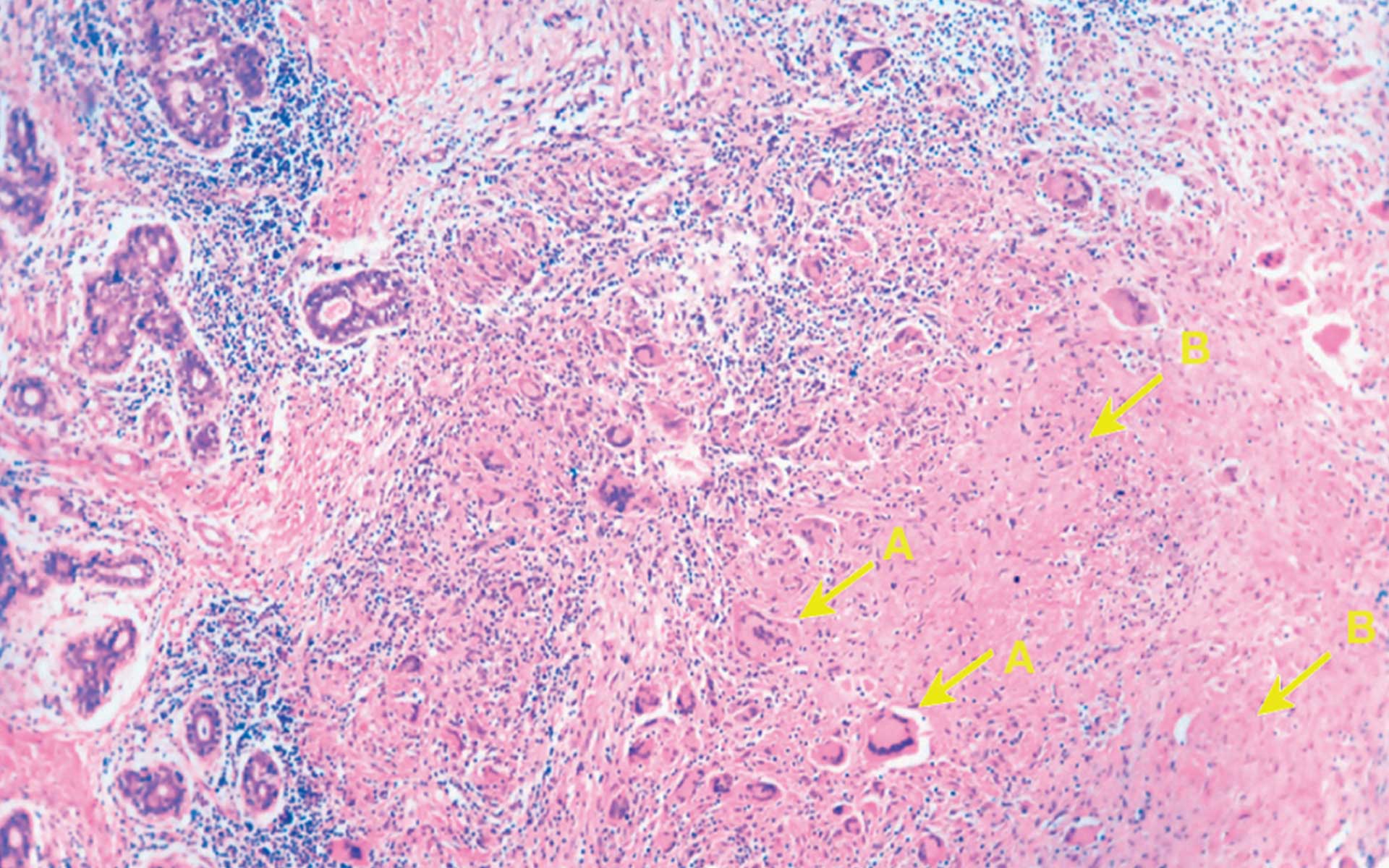 Tuberculosis
