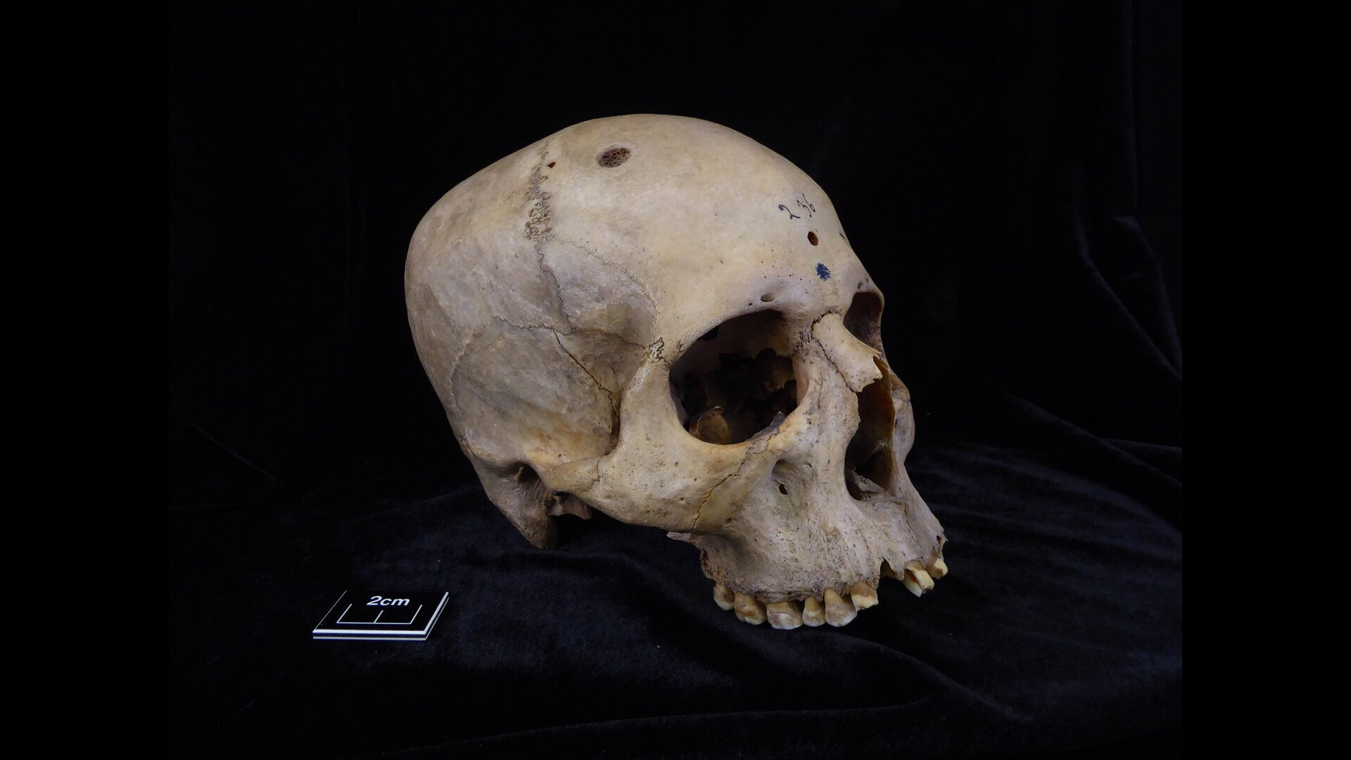 Extraordinary' 4,000 Year Old Egyptian Skull May Show Signs Of Attempts To Treat Cancer