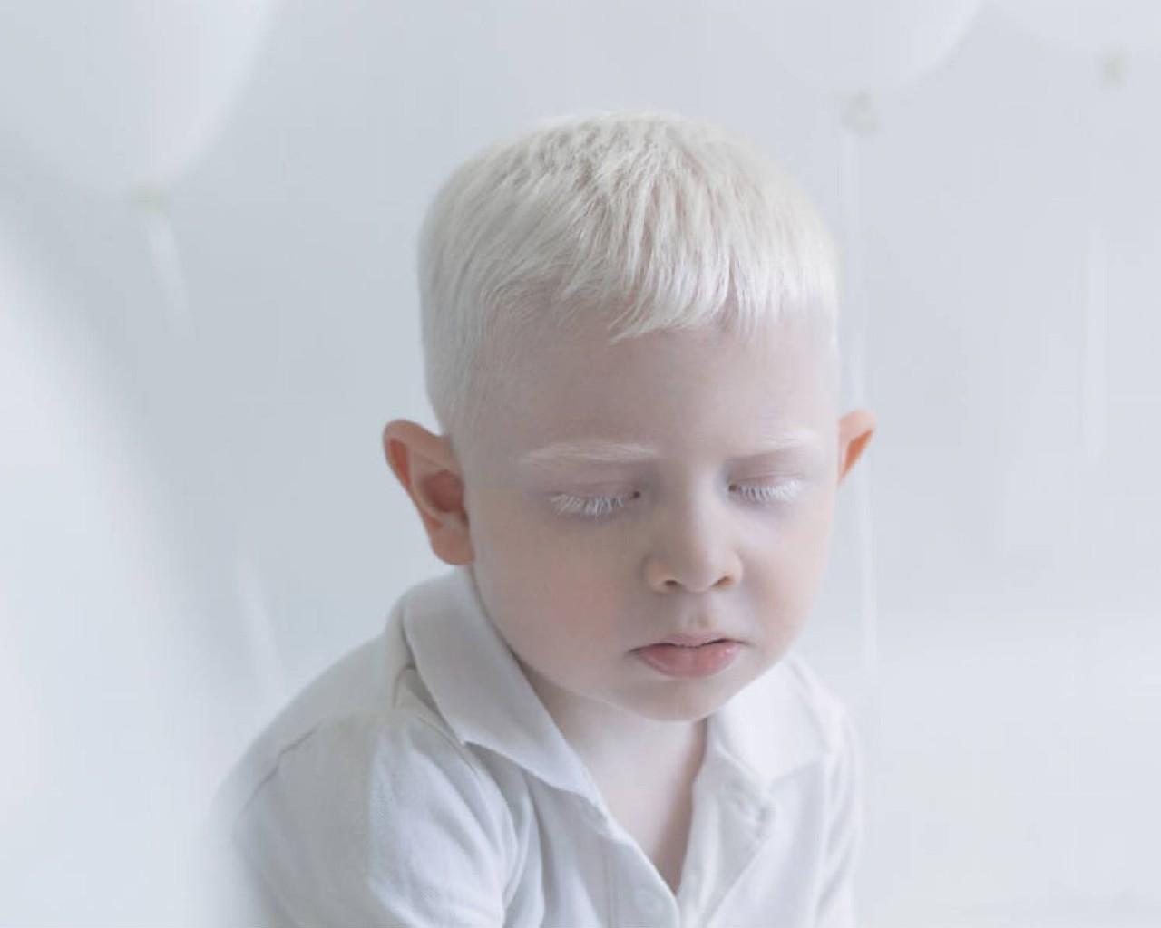 Albinos People Wallpaper APK for Android Download