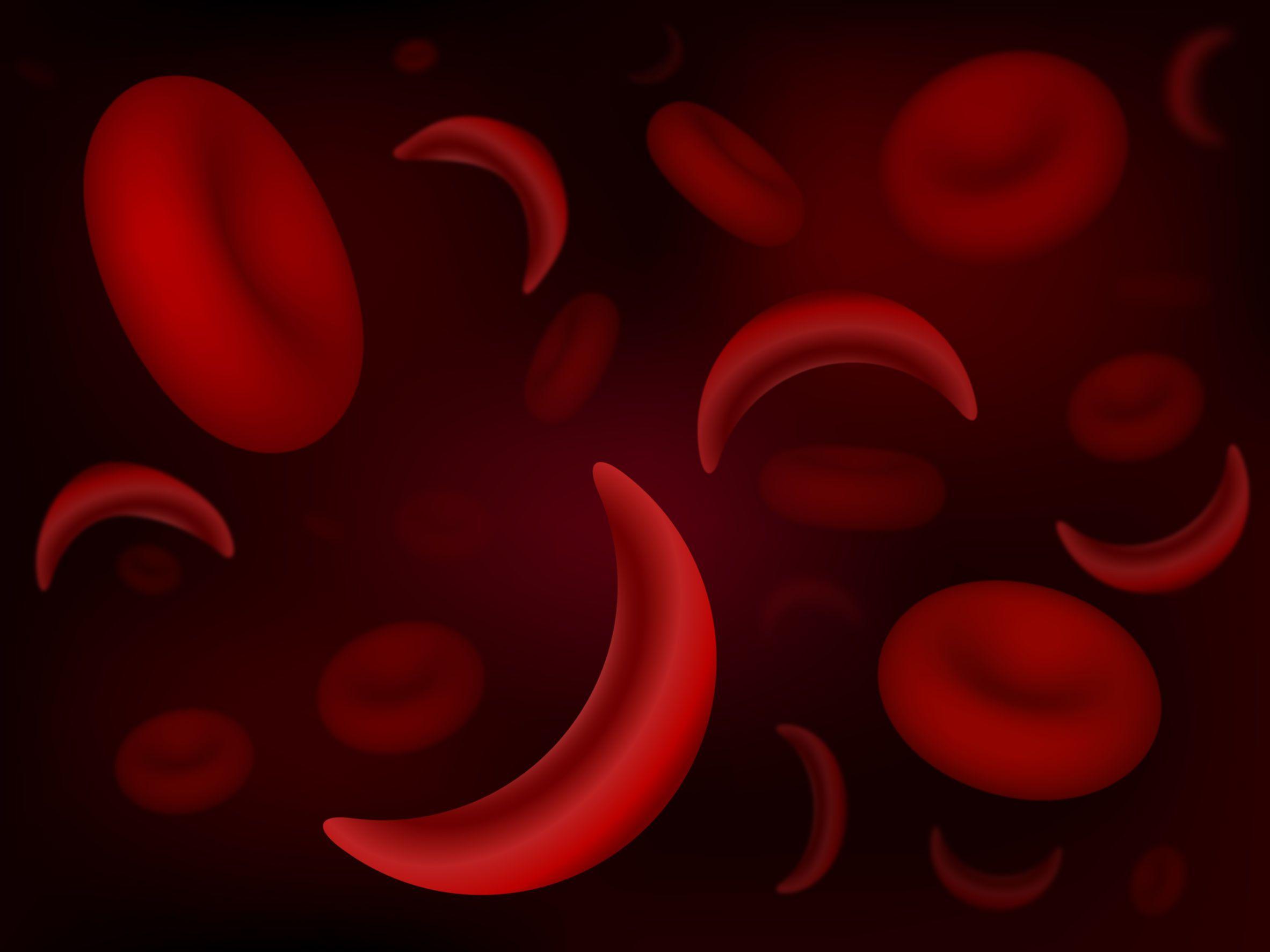 Sickle Cell Disease Overview